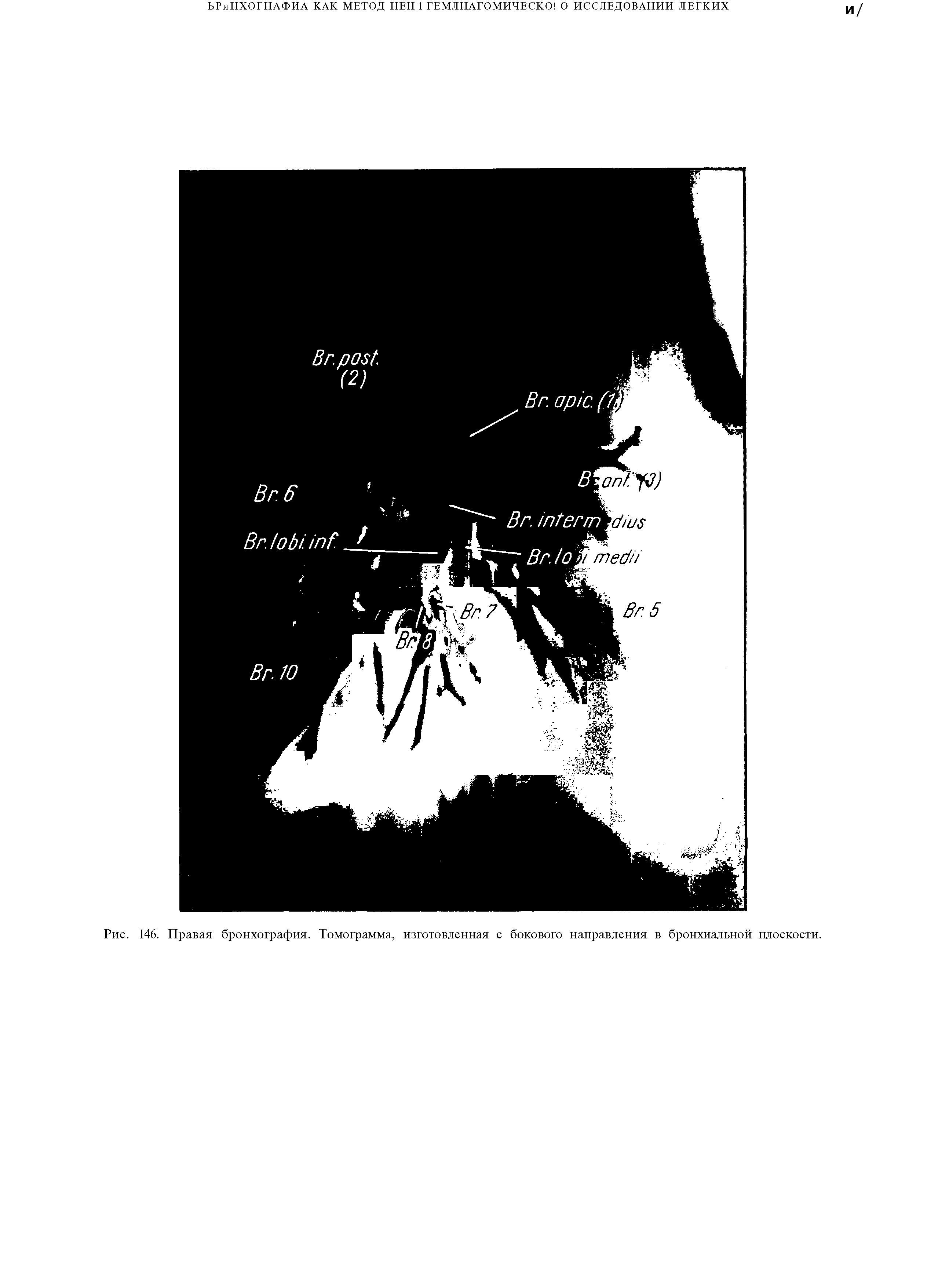 Рис. 146. Правая бронхография. Томограмма, изготовленная с бокового направления в бронхиальной плоскости.