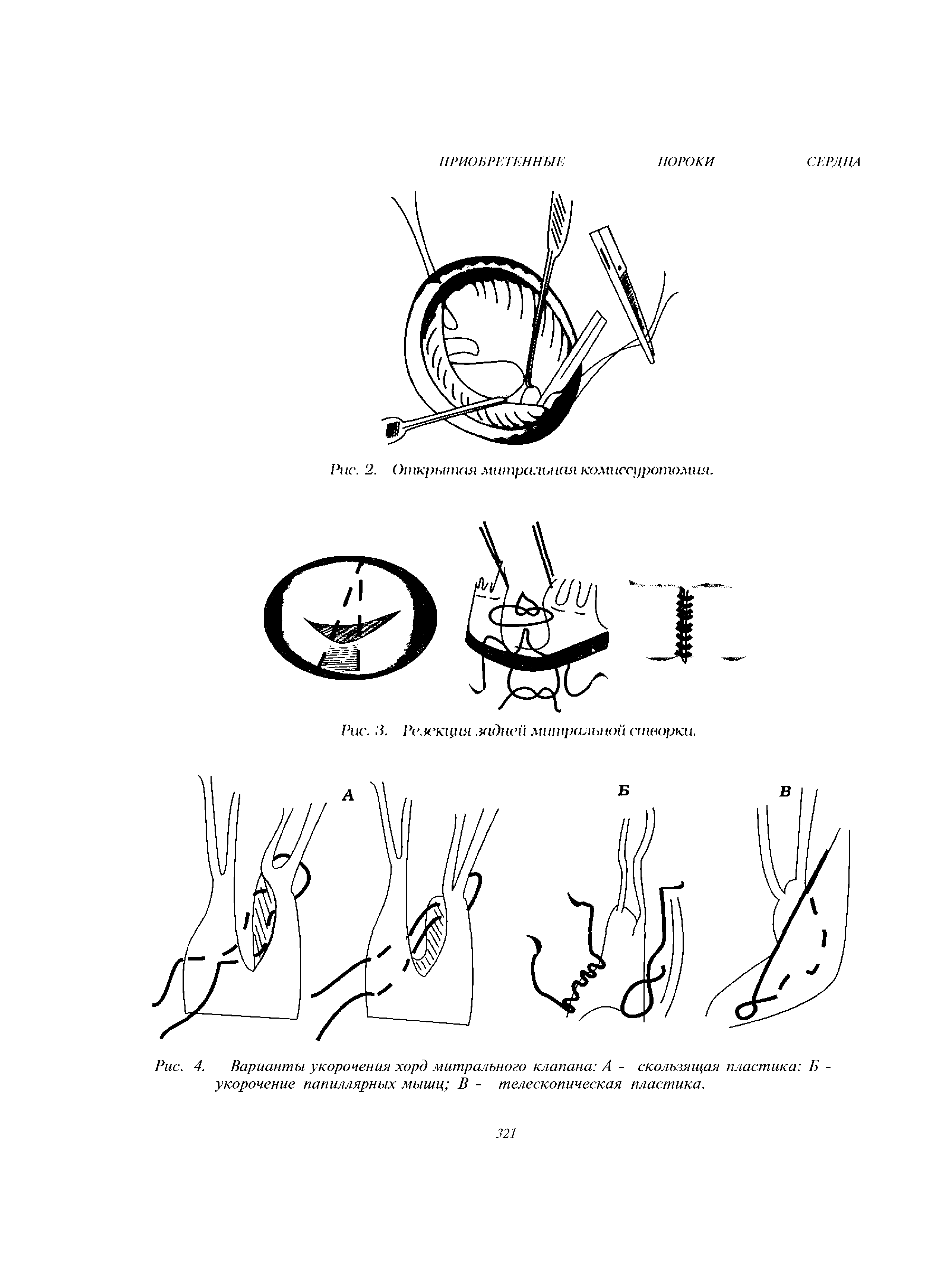 Рис. 4. Варианты укорочения хорд митрального клапана А - скользящая пластика Б -укорочение папиллярных мышц В - телескопическая пластика.