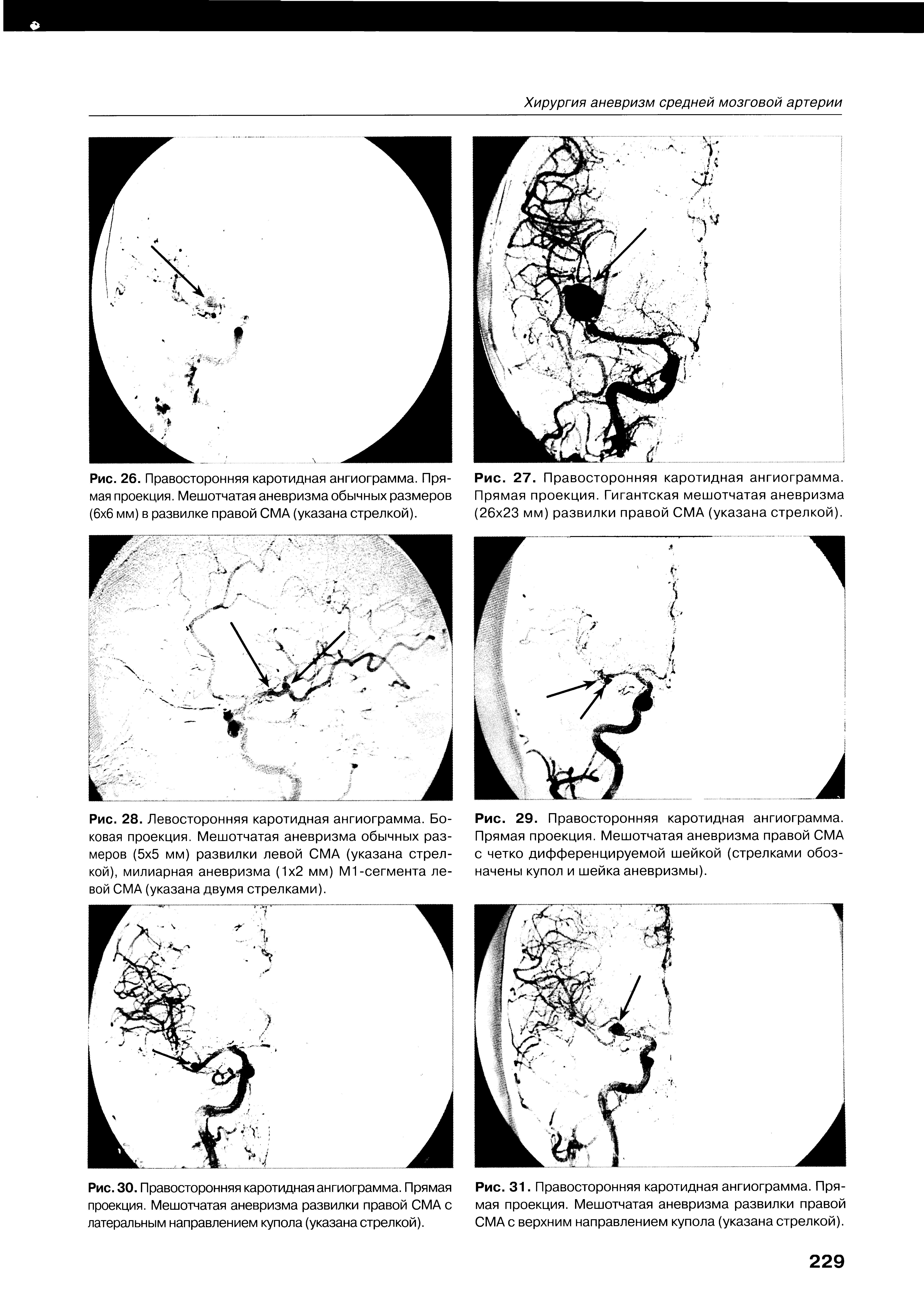 Рис. 28. Левосторонняя каротидная ангиограмма. Боковая проекция. Мешотчатая аневризма обычных размеров (5 5 мм) развилки левой СМА (указана стрелкой), милиарная аневризма (1 2 мм) М1-сегмента левой СМА (указана двумя стрелками).