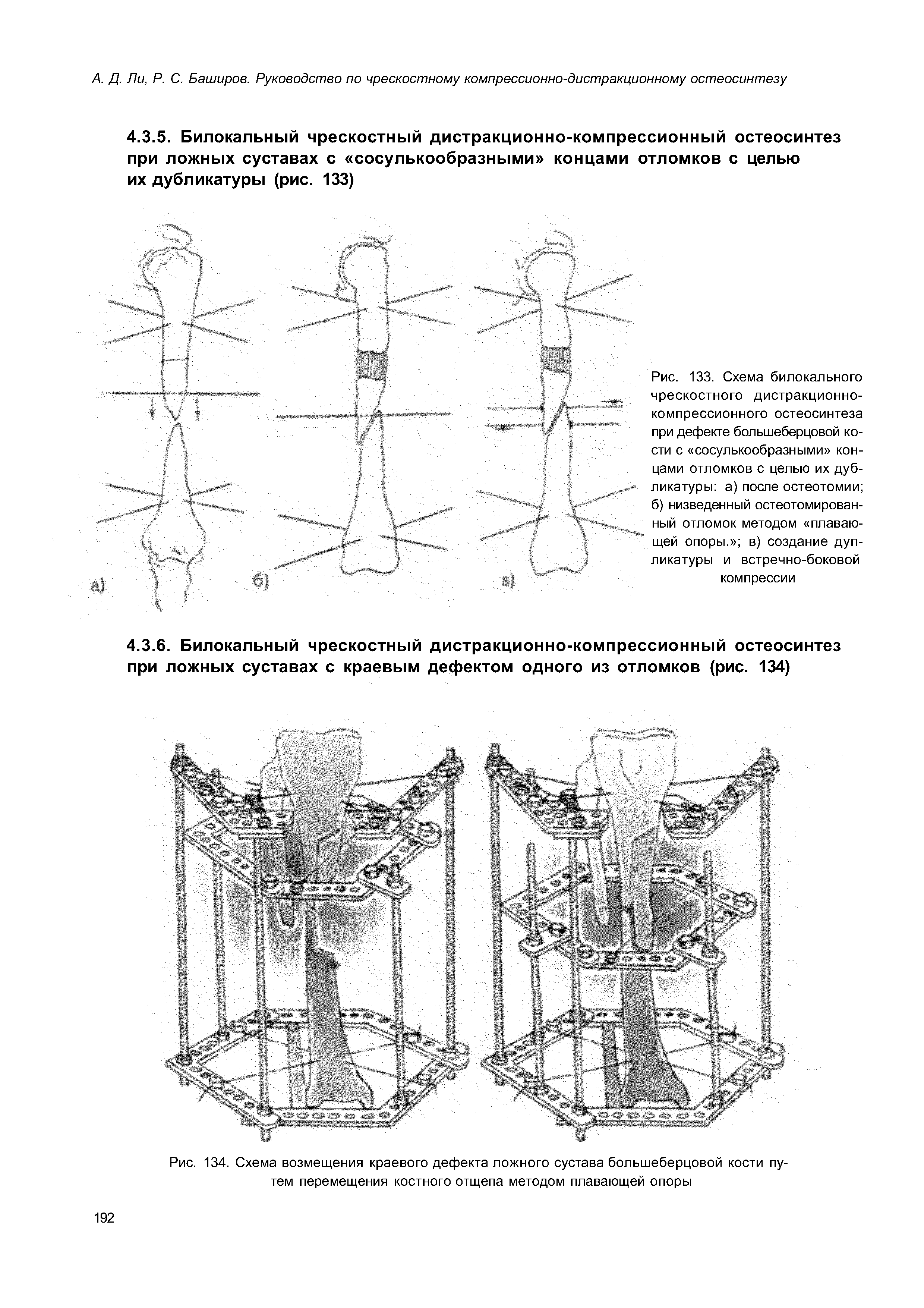 Рис. 133. Схема билокального чрескостного дистракционнокомпрессионного остеосинтеза при дефекте большеберцовой кости с сосулькообразными концами отломков с целью их дубликатуры а) после остеотомии б) низведенный остеотомирован-ный отломок методом плавающей опоры. в) создание дуп-ликатуры и встречно-боковой...
