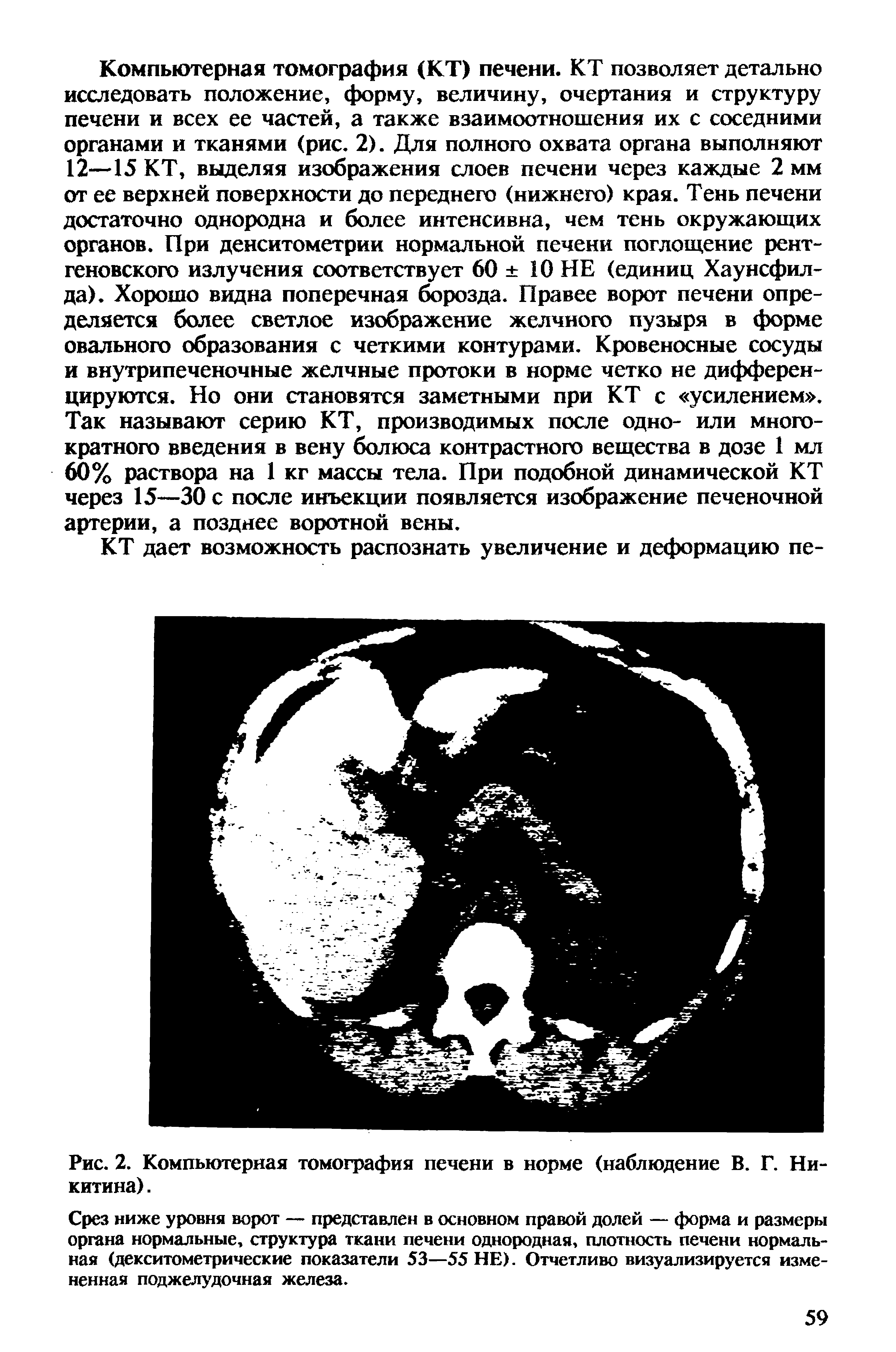 Рис. 2. Компьютерная томография печени в норме (наблюдение В. Г. Никитина). ...