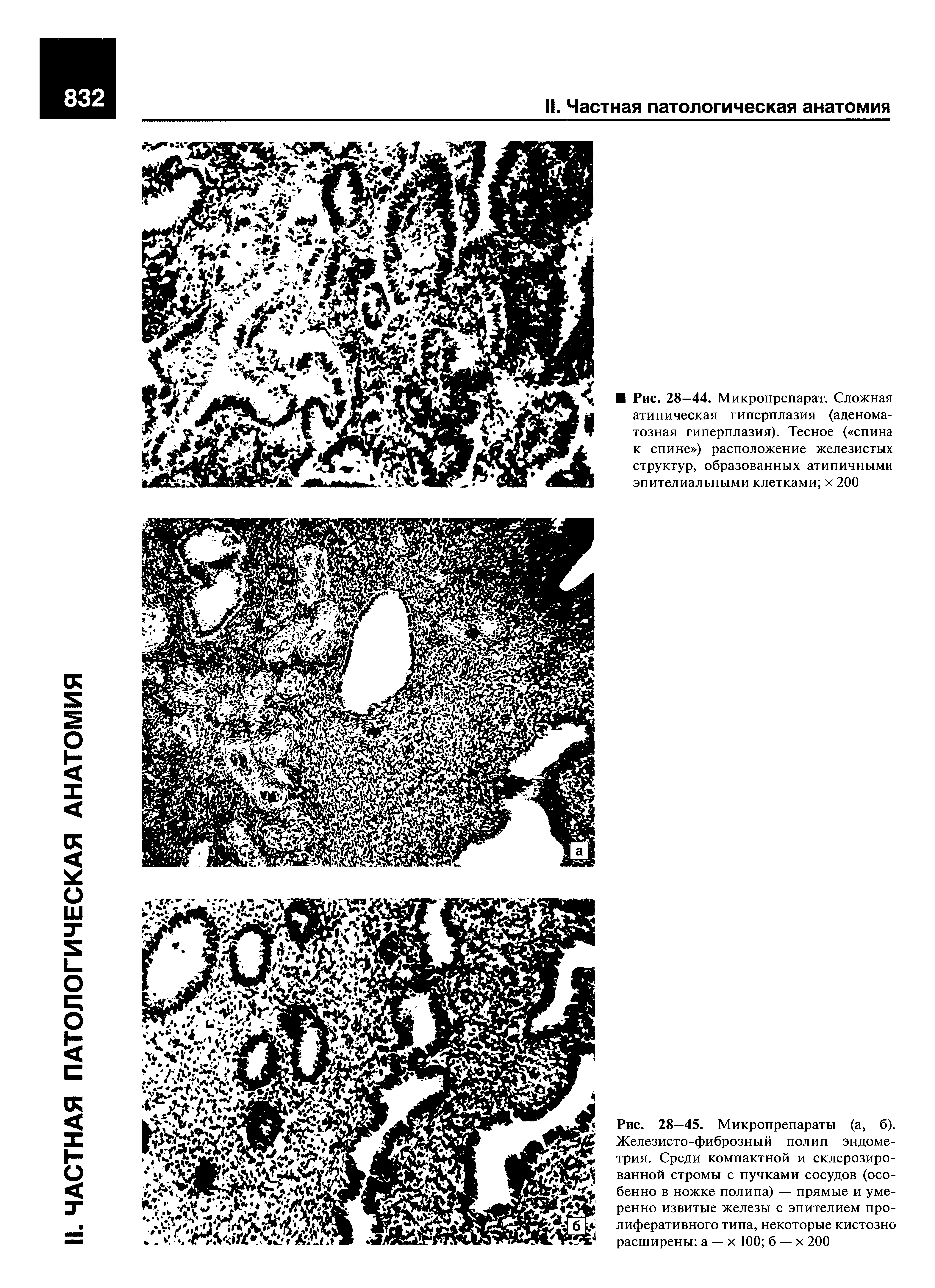 Рис. 28—45. Микропрепараты (а, б). Железисто-фиброзный полип эндометрия. Среди компактной и склерозированной стромы с пучками сосудов (особенно в ножке полипа) — прямые и умеренно извитые железы с эпителием пролиферативного типа, некоторые кистозно расширены а — х 100 б — х 200...
