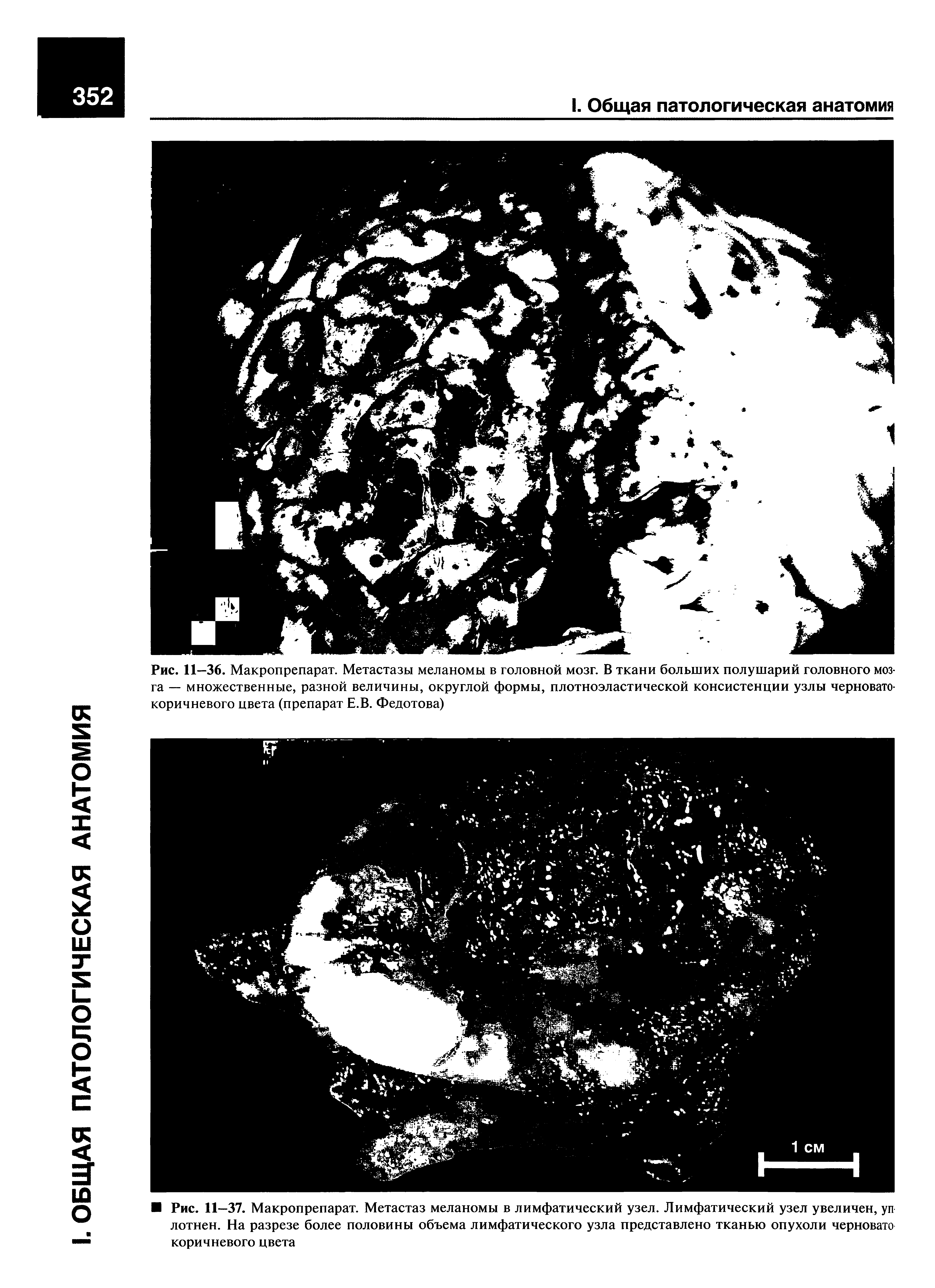 Рис. 11—36. Макропрепарат. Метастазы меланомы в головной мозг. В ткани больших полушарий головного мозга — множественные, разной величины, округлой формы, плотноэластической консистенции узлы черноватокоричневого цвета (препарат Е.В. Федотова)...