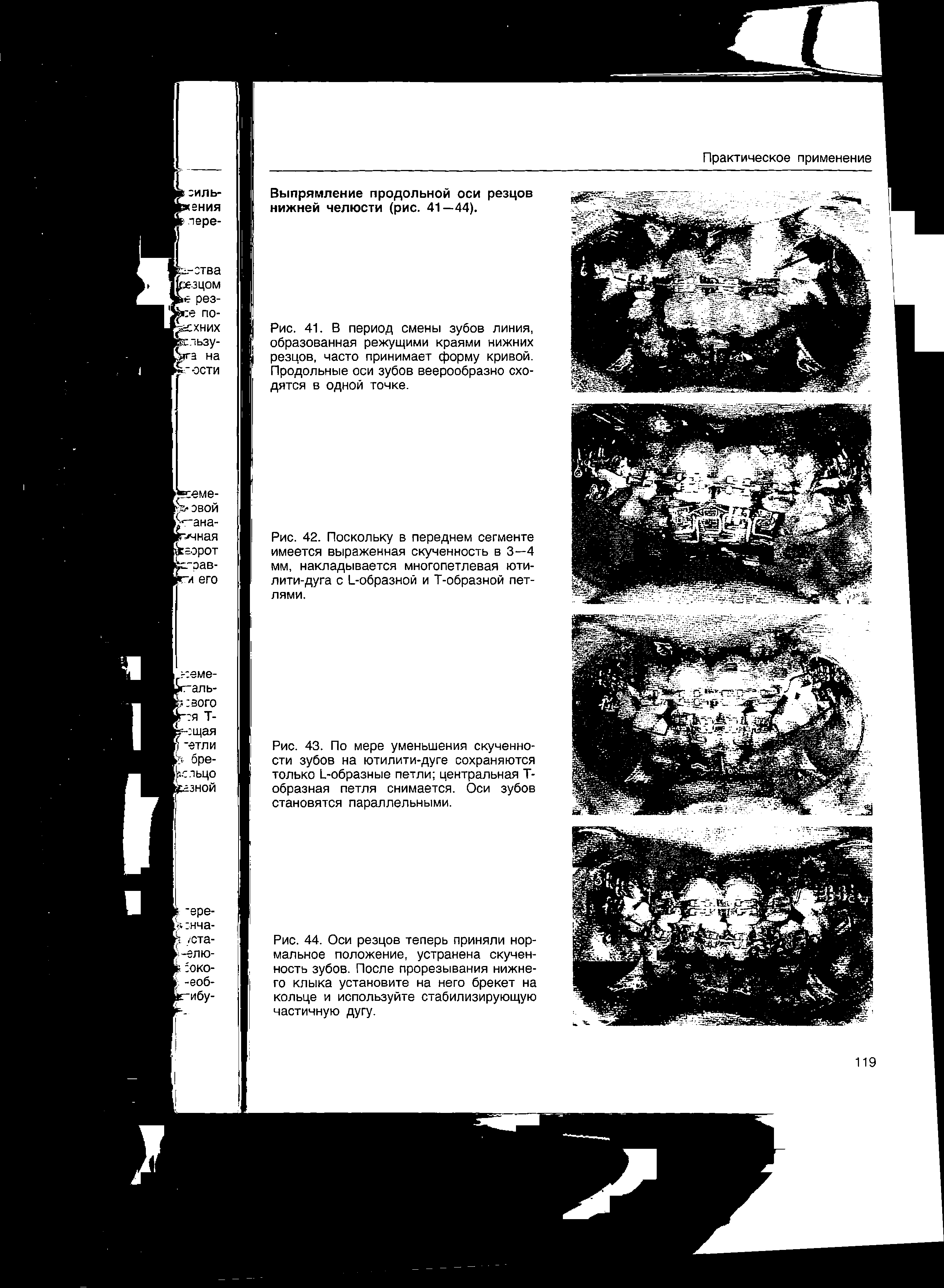 Рис. 44. Оси резцов теперь приняли нормальное положение, устранена скученность зубов. После прорезывания нижнего клыка установите на него брекет на кольце и используйте стабилизирующую частичную дугу.