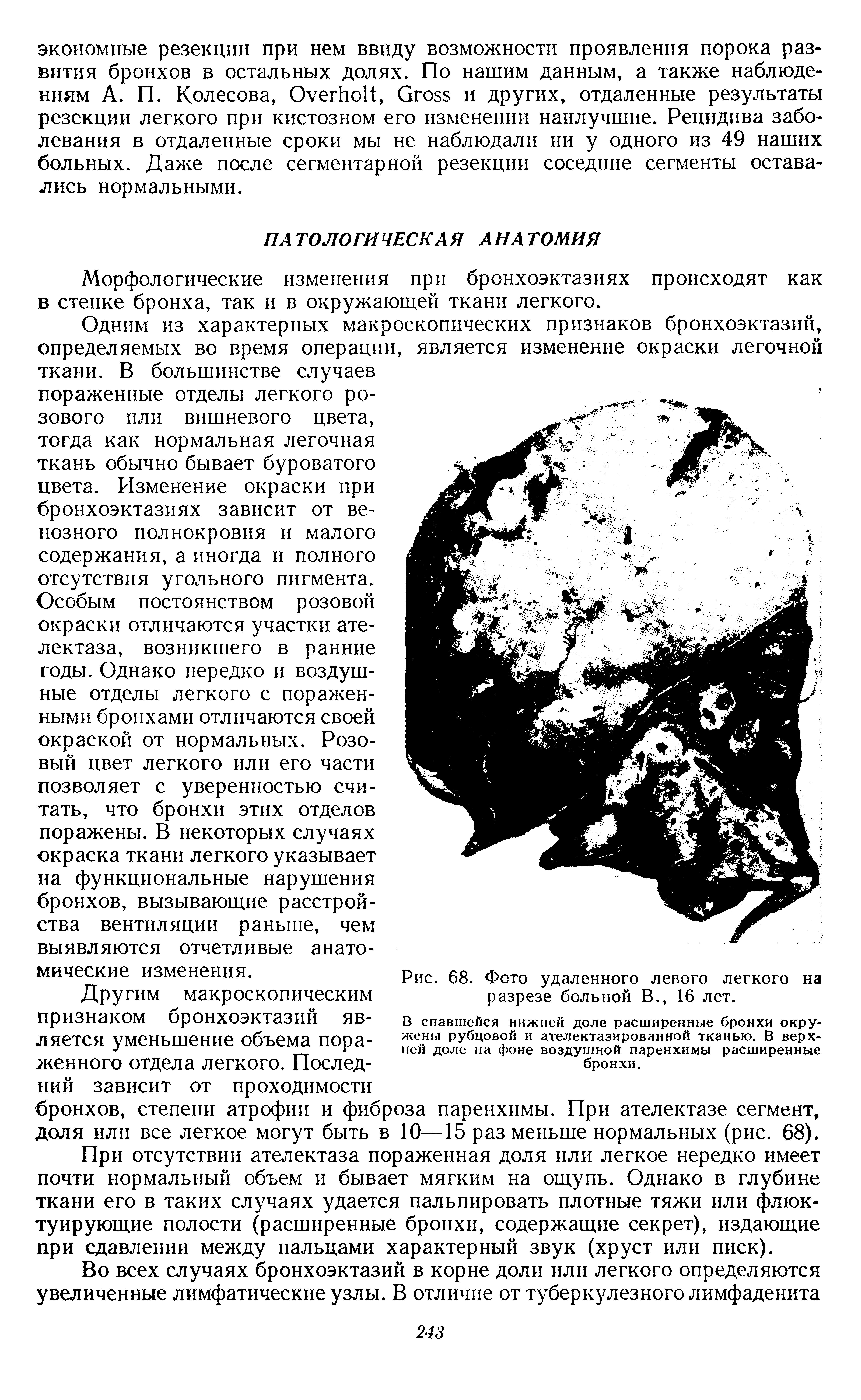 Рис. 68. Фото удаленного левого легкого на разрезе больной В., 16 лет.