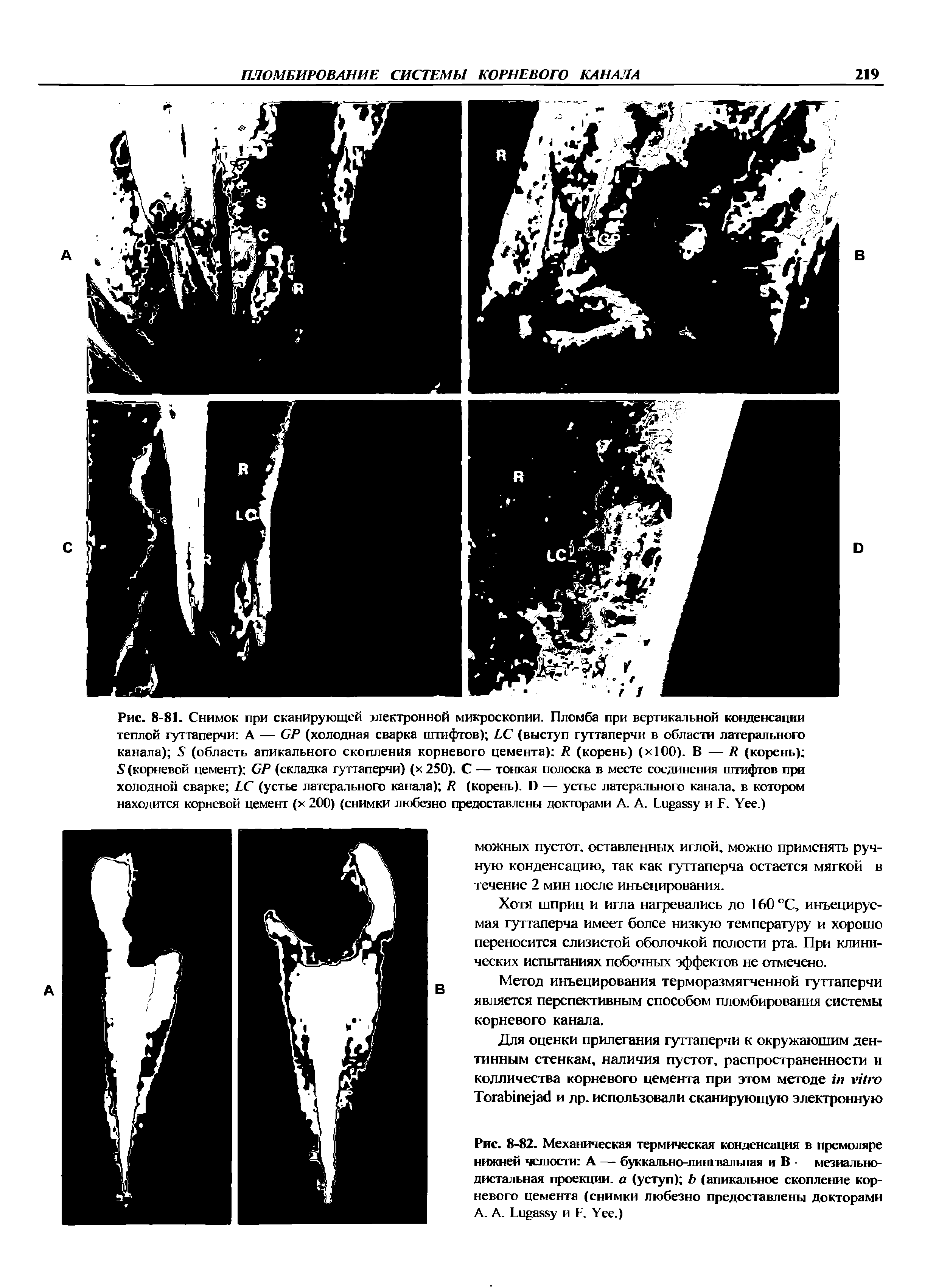 Рис. 8-82. Механическая термическая конденсация в премоляре нижней челюсти А — буккально-лингвальная и В - мезиальнодистальная проекции, а (уступ) Ь (апикальное скопление корневого цемента (снимки любезно предоставлены докторами A. A. L и F. Y .)...