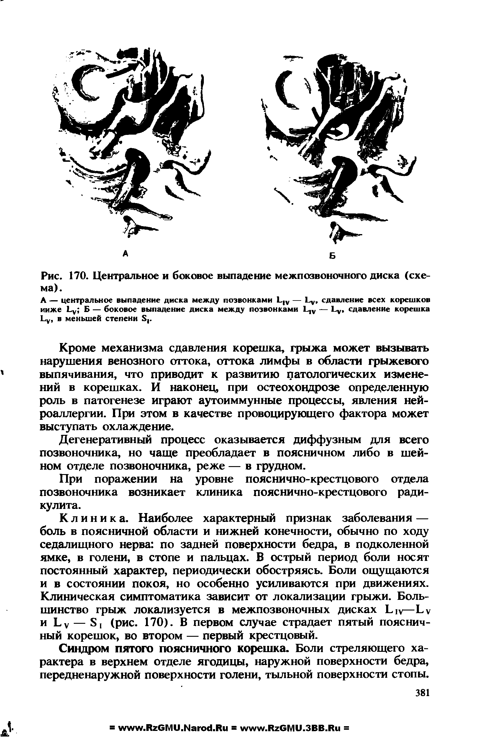 Рис. 170. Центральное и боковое выпадение межпозвоночного диска (схема).