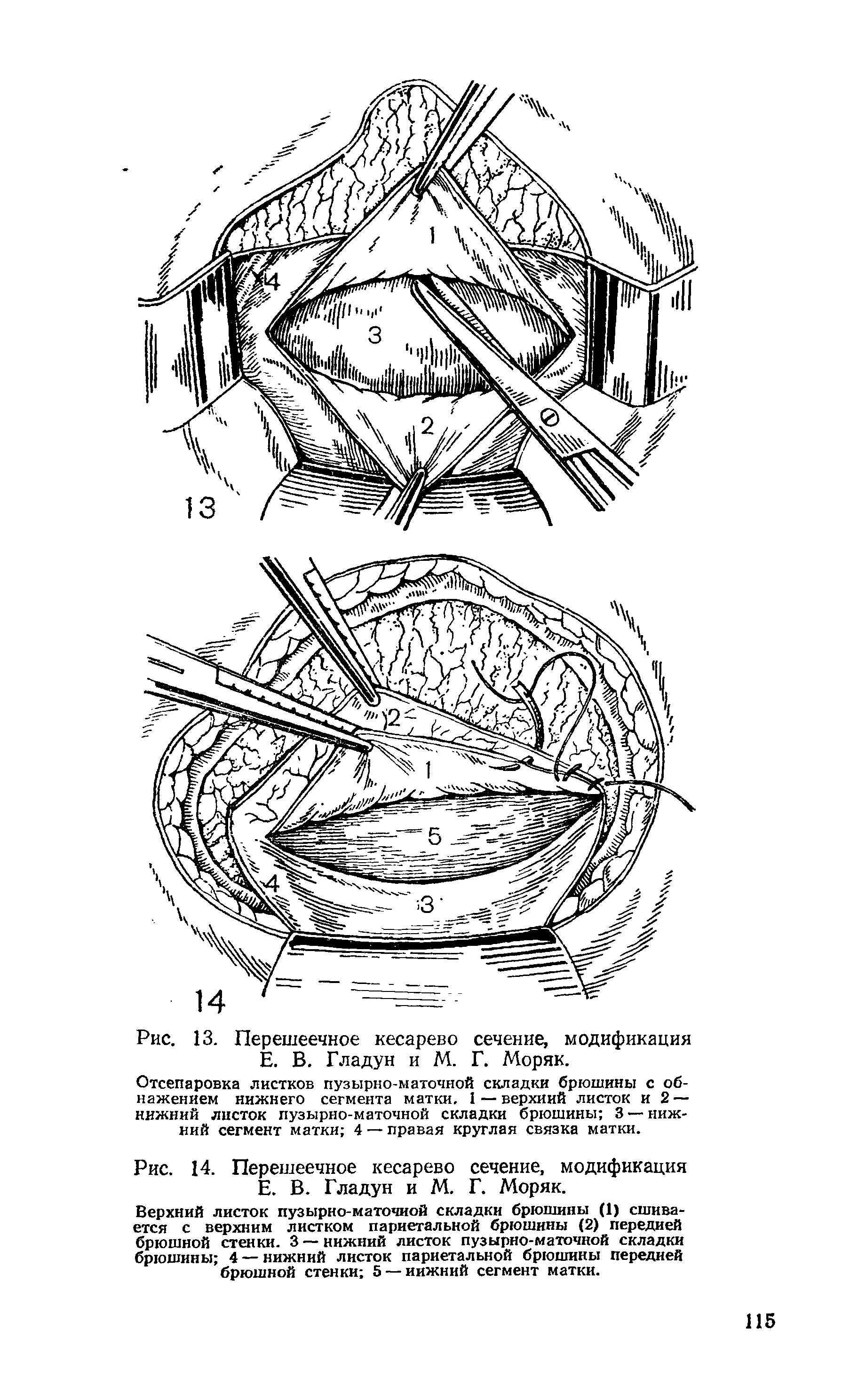 Рис. 13. Перешеечное кесарево сечение, модификация Е. В. Гладун и М. Г. Моряк.