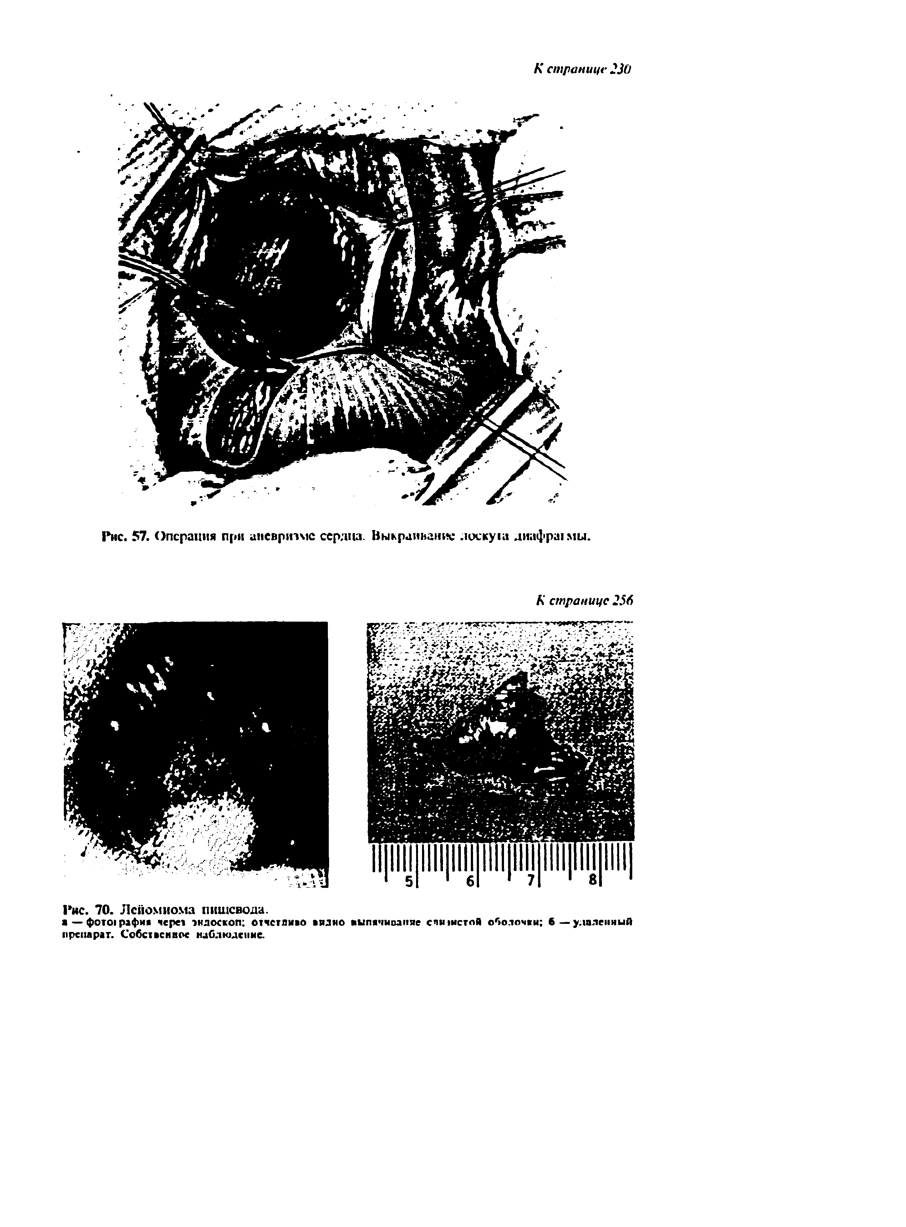 Рис. 57. Операция при аневризме сердца. Выкраивание. текут днафра1мы.