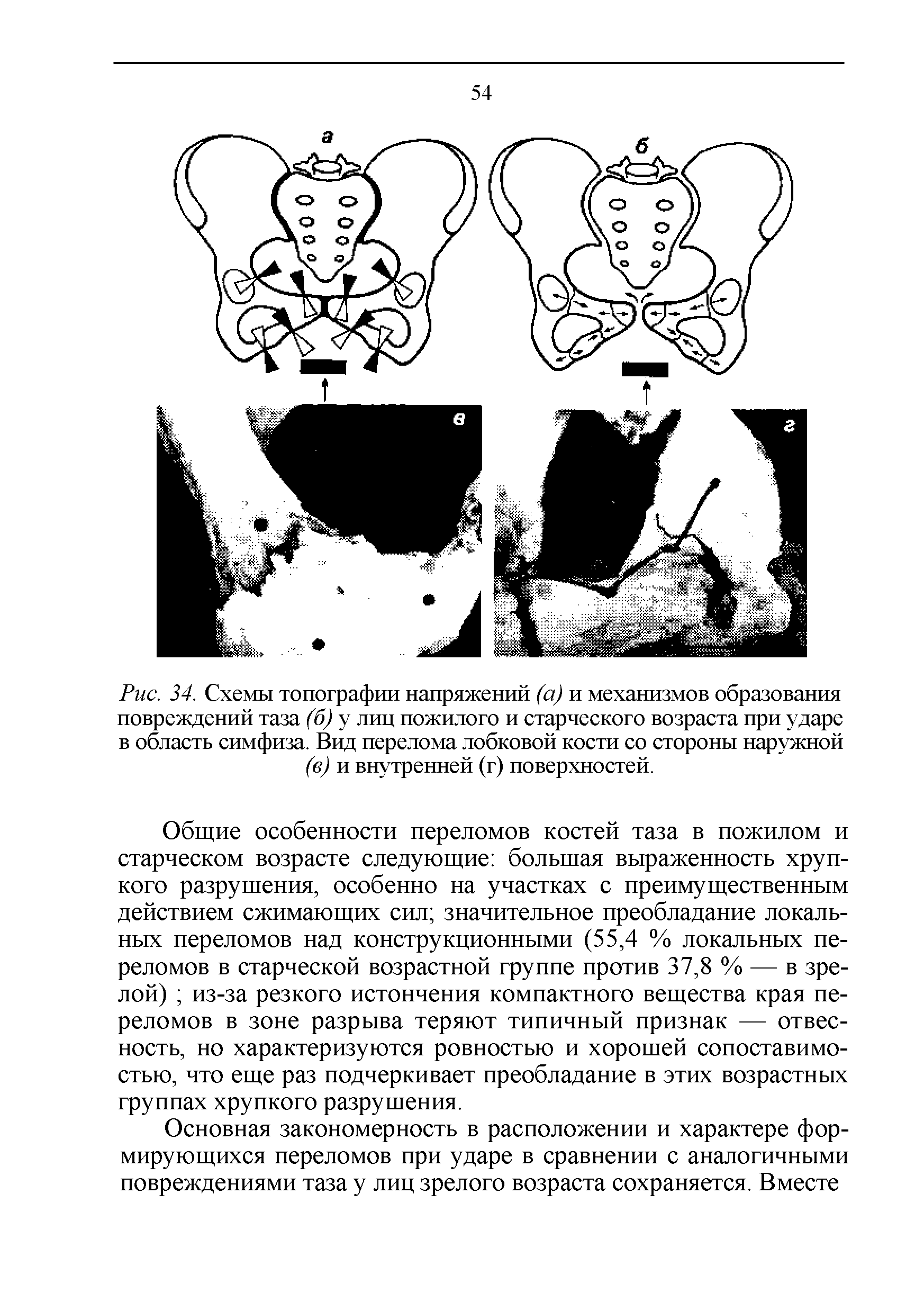 Рис. 34. Схемы топографии напряжений (а) и механизмов образования повреждений таза (б) у лиц пожилого и старческого возраста при ударе в область симфиза. Вид перелома лобковой кости со стороны наружной (в) и внутренней (г) поверхностей.