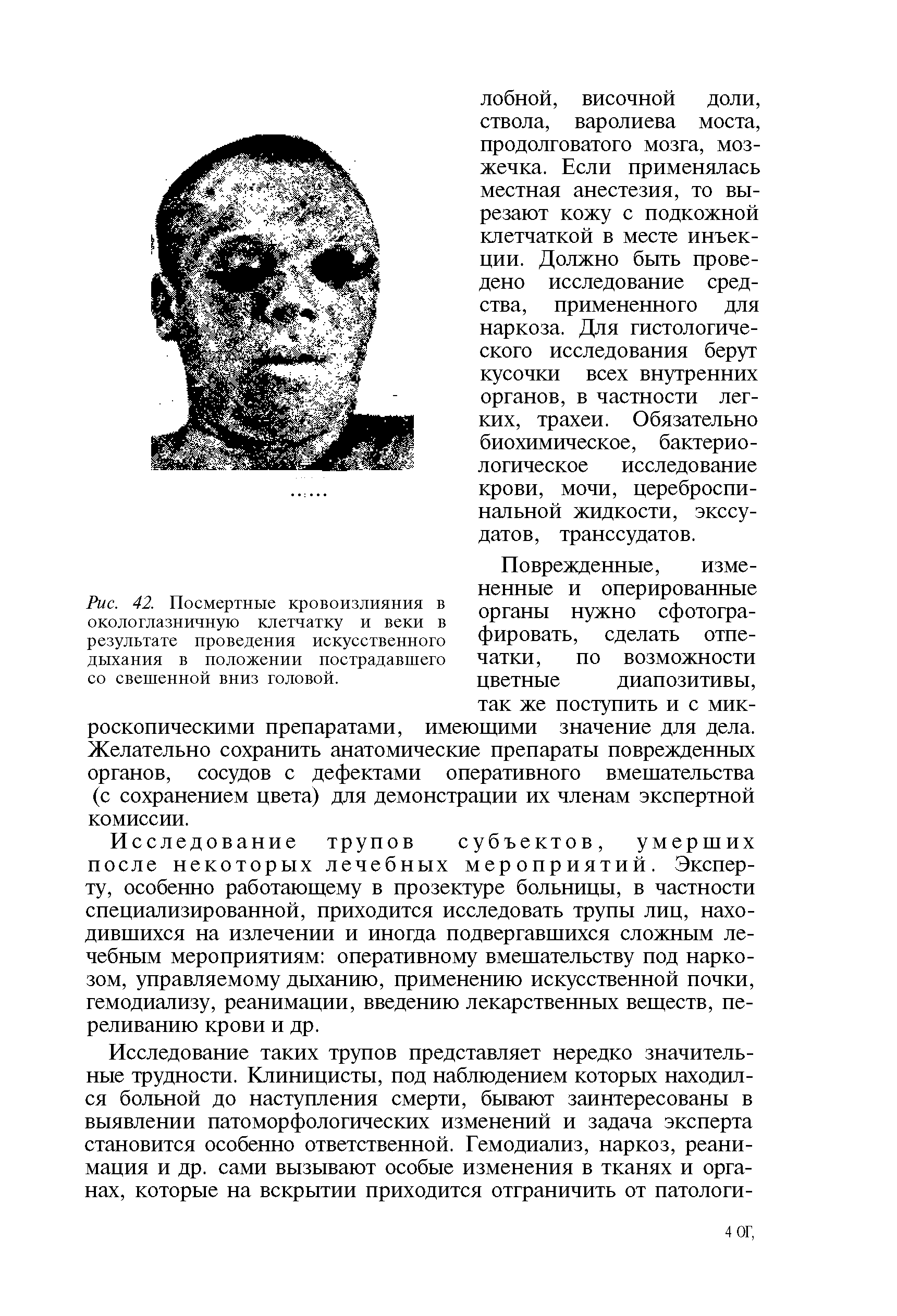 Рис. 42. Посмертные кровоизлияния в окологлазничную клетчатку и веки в результате проведения искусственного дыхания в положении пострадавшего со свешенной вниз головой.