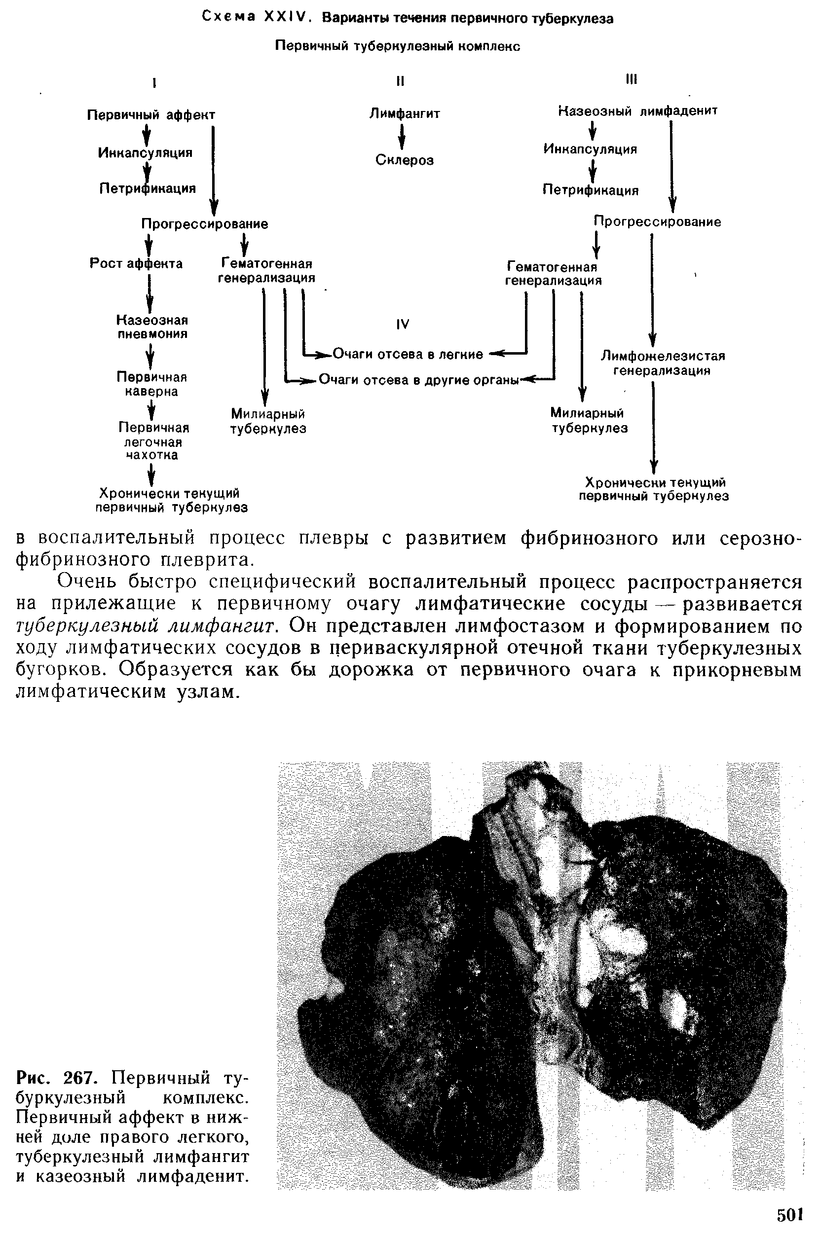 Рис. 267. Первичный ту-буркулезный комплекс. Первичный аффект в нижней доле правого легкого, туберкулезный лимфангит и казеозный лимфаденит.