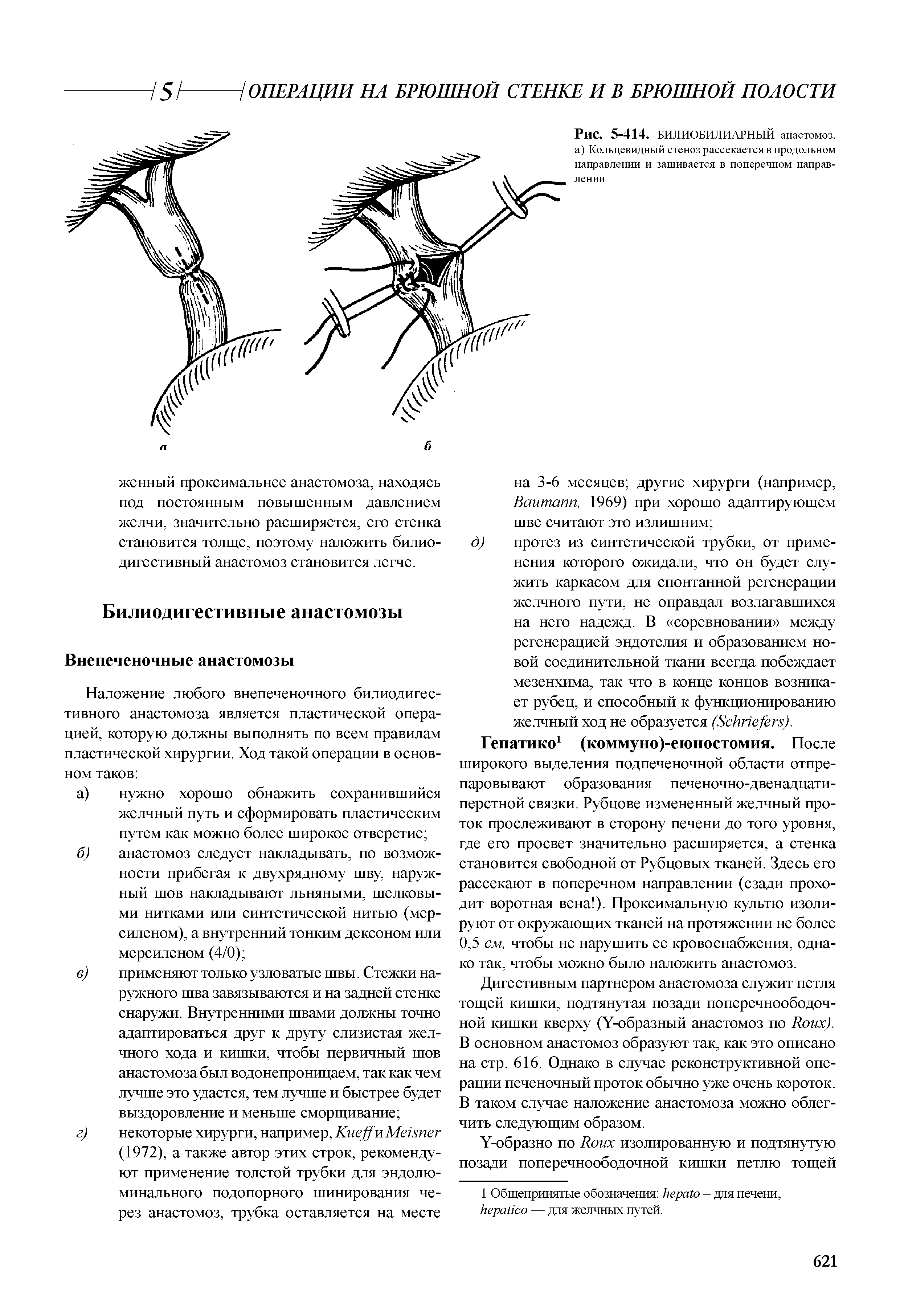 Рис. 5-414. БИЛИОБИЛИАРНЫЙ анастомоз, а) Кольцевидный стеноз рассекается в продольном направлении и зашивается в поперечном направлении...