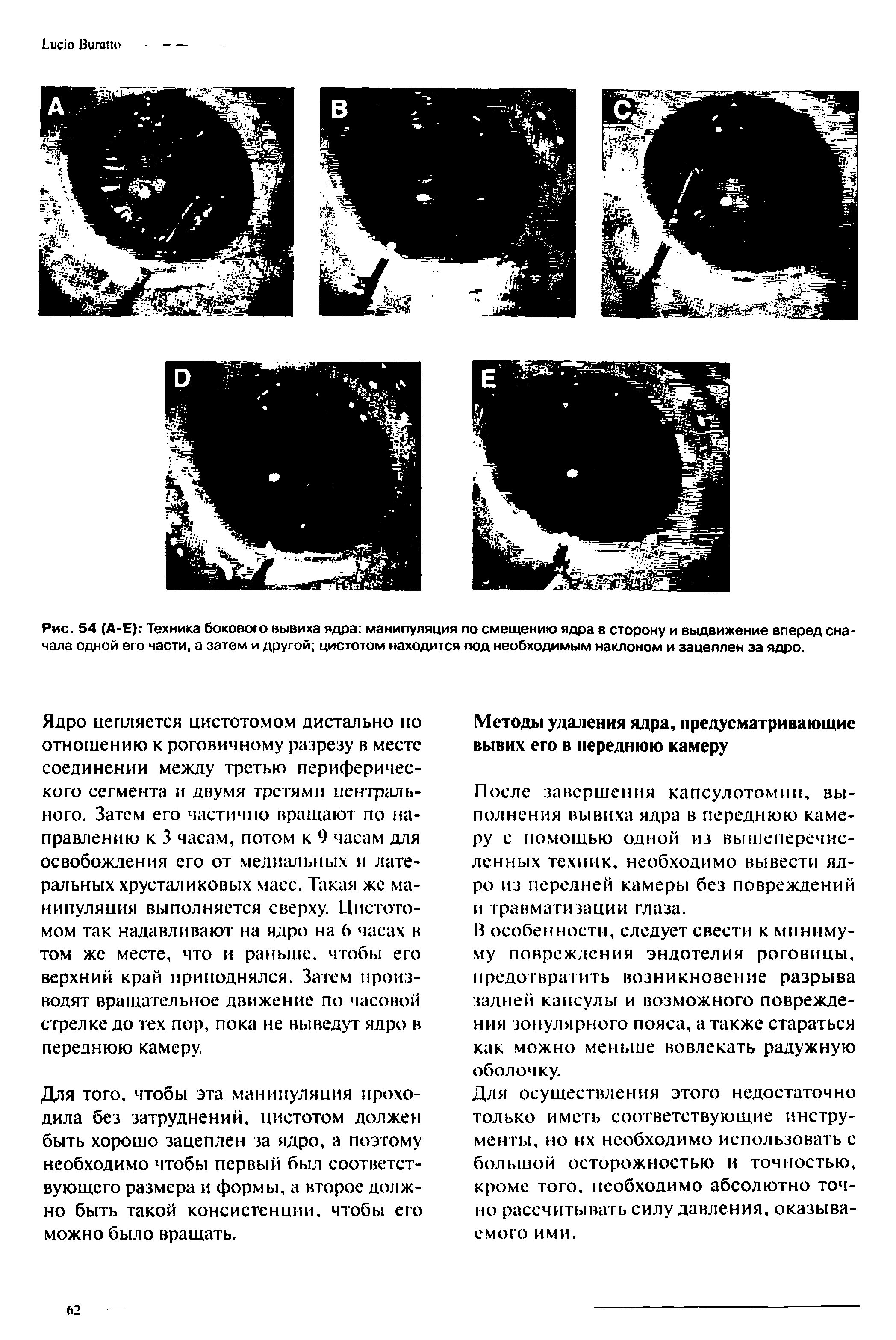 Рис. 54 (А-Е) Техника бокового вывиха ядра манипуляция по смещению ядра в сторону и выдвижение вперед сначала одной его части, а затем и другой цистотом находится под необходимым наклоном и зацеплен за ядро.