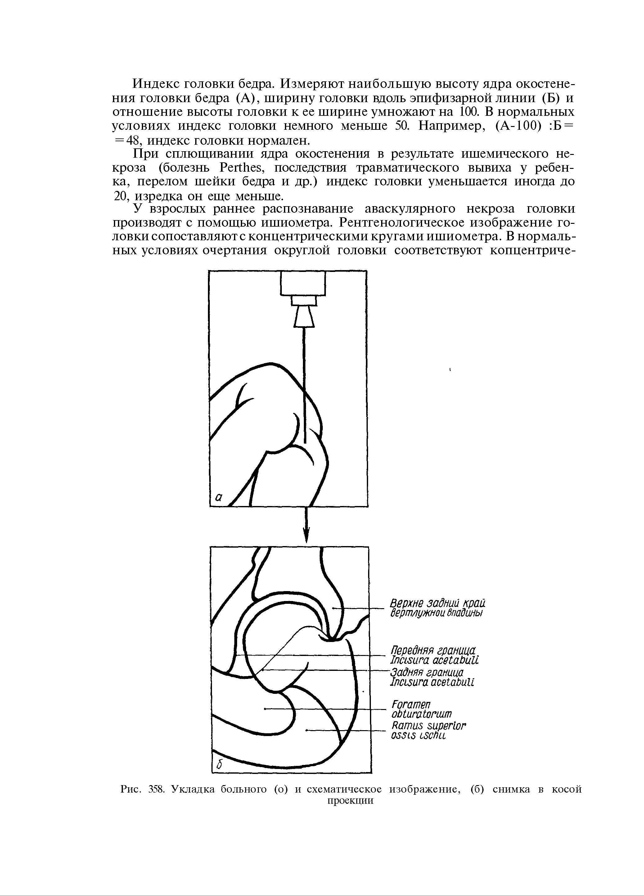 Рис. 358. Укладка больного (о) и схематическое изображение, (б) снимка в косой проекции...