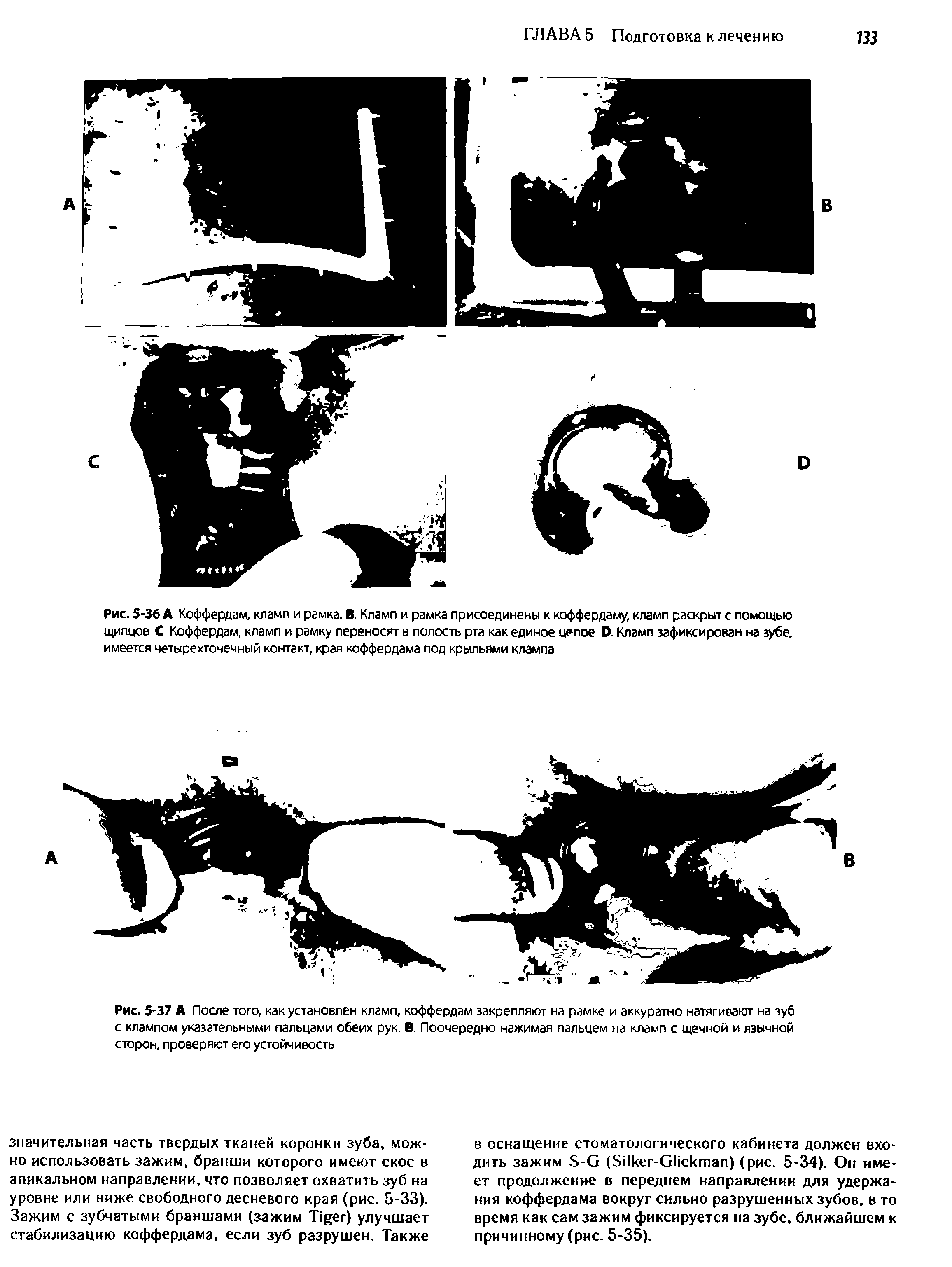 Рис. 5-36 А Коффердам, кламп и рамка. В. Кламп и рамка присоединены к коффердаму, кламп раскрыт с помощью щипцов С Коффердам, кламп и рамку переносят в полость рта как единое целое О. Кламп зафиксирован на зубе, имеется четырехточечный контакт, края коффердама под крыльями клампа...