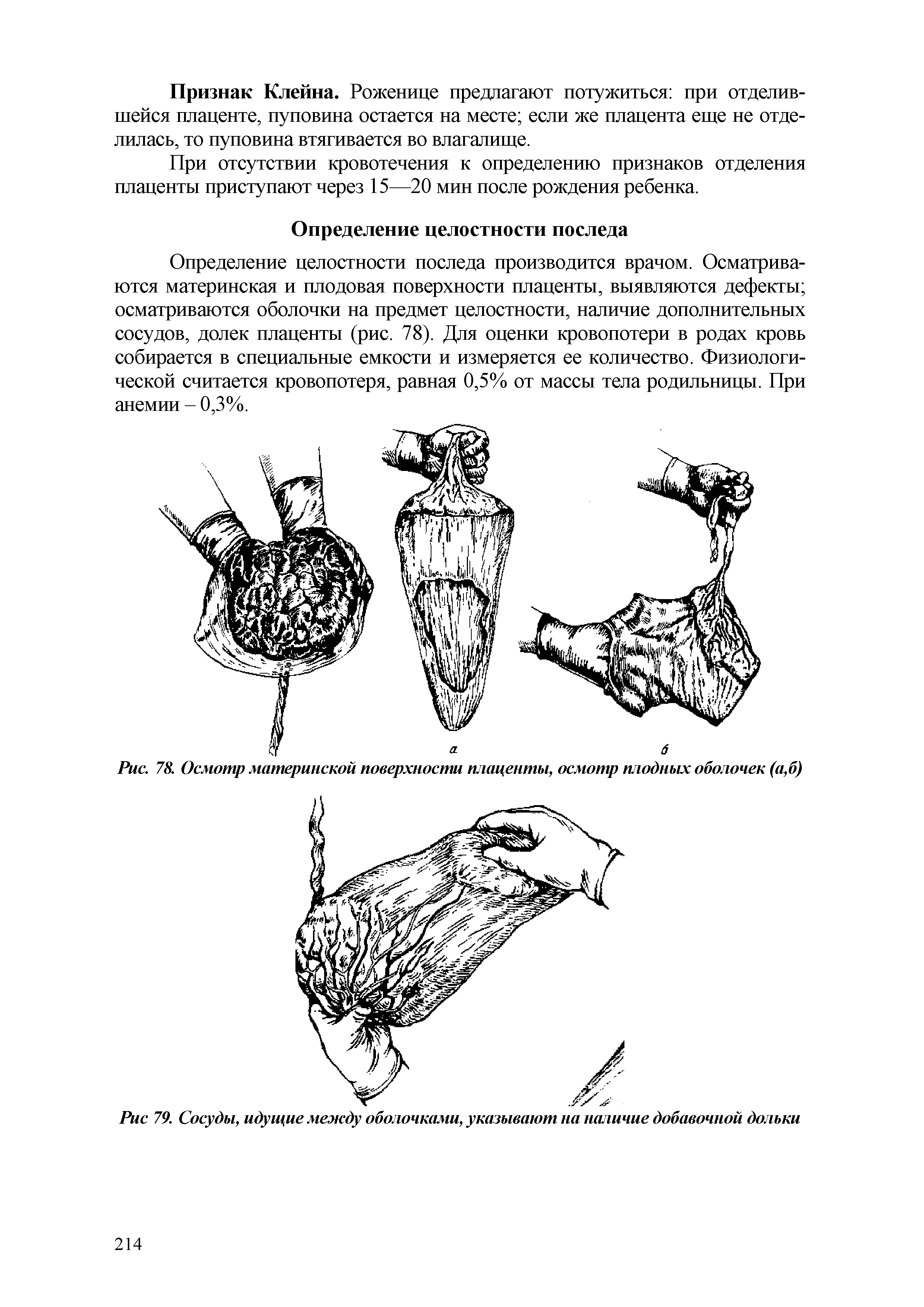 Рис. 78. Осмотр материнской поверхности плаценты, осмотр плодных оболочек (а,б)...