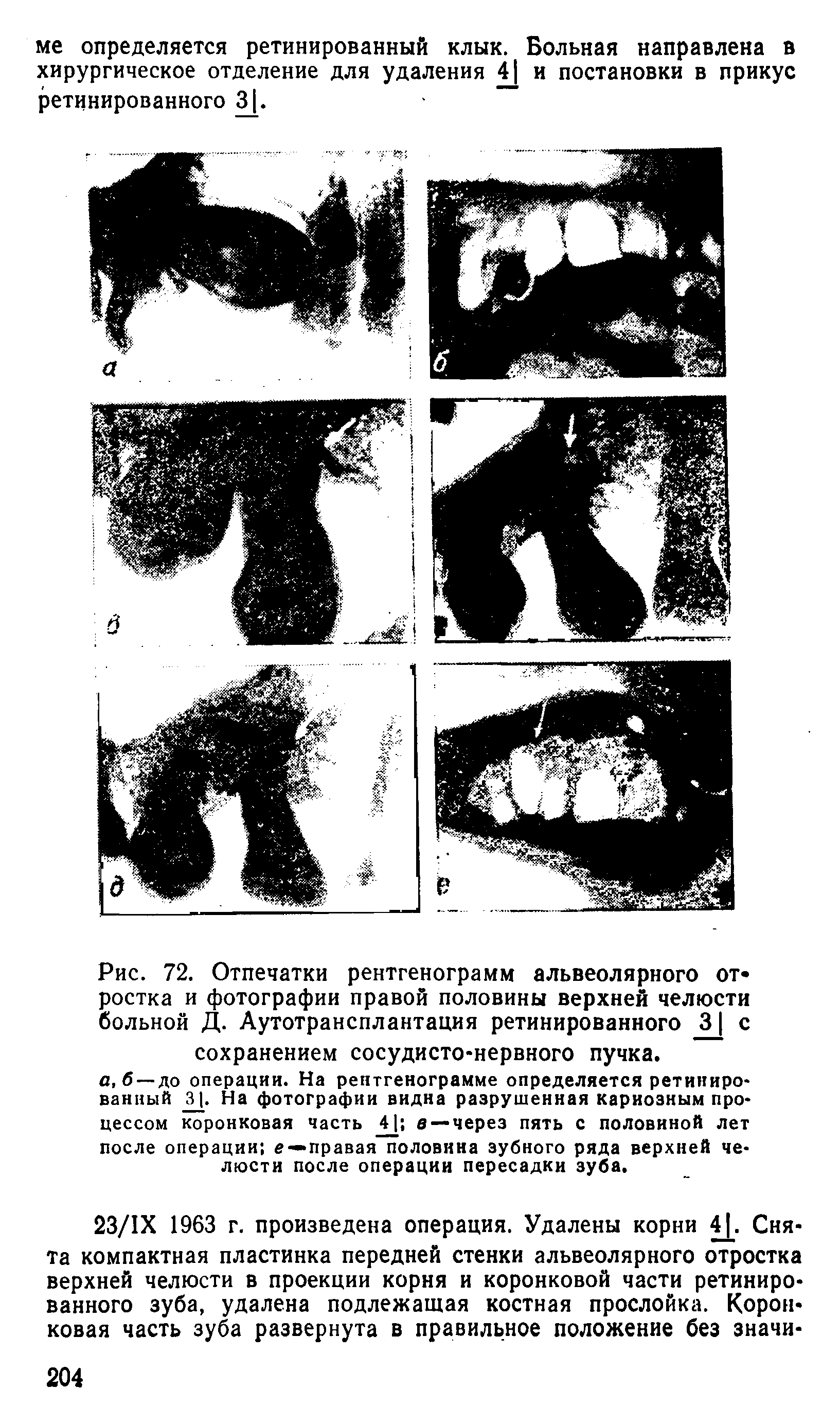 Рис. 72. Отпечатки рентгенограмм альвеолярного от ростка и фотографии правой половины верхней челюсти больной Д. Аутотрансплантация ретинированного 31 с сохранением сосудисто-нервного пучка.