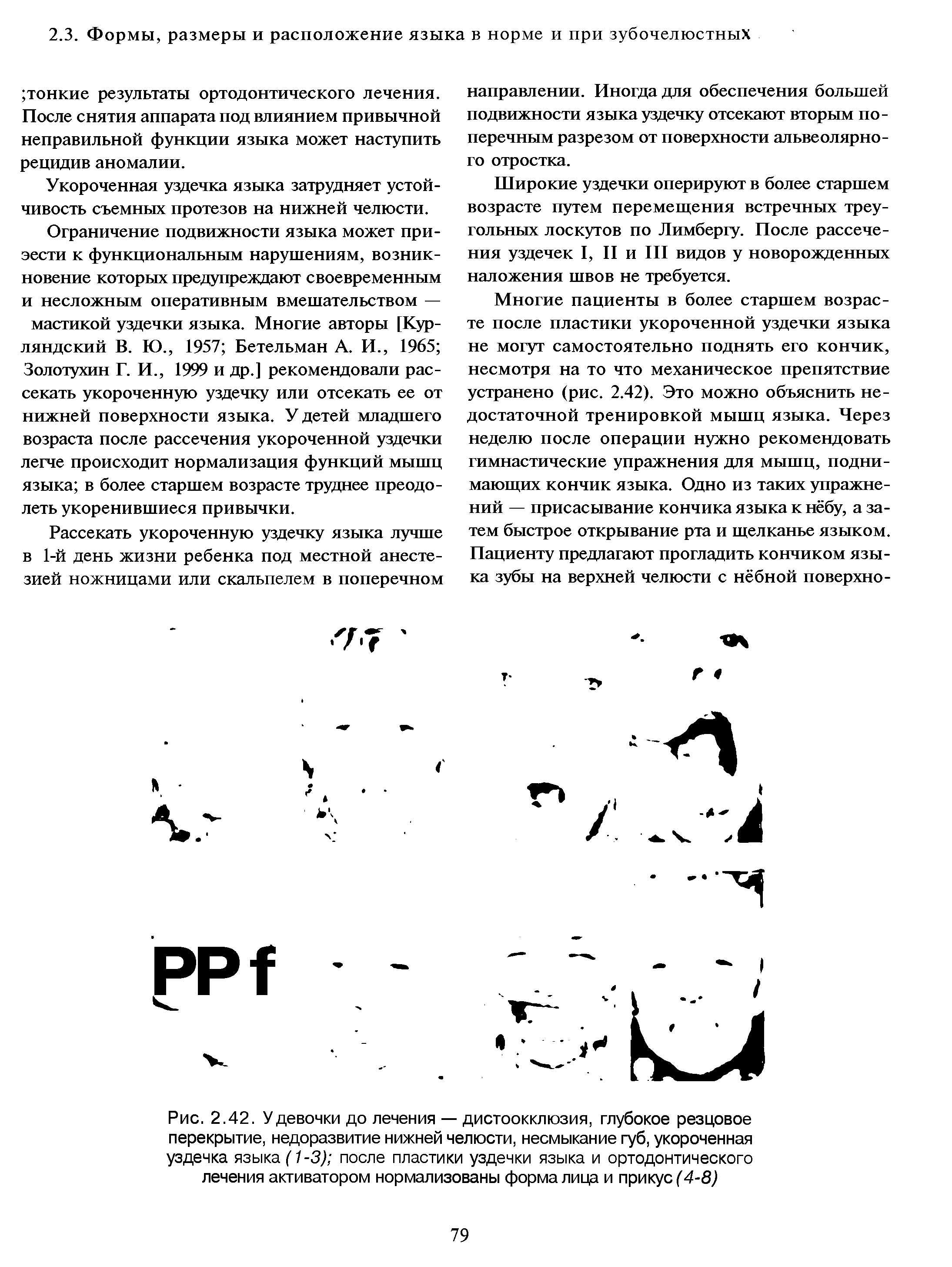 Рис. 2.42. У девочки до лечения — дистоокклюзия, глубокое резцовое перекрытие, недоразвитие нижней челюсти, несмыкание губ, укороченная уздечка языка (1-3) после пластики уздечки языка и ортодонтического лечения активатором нормализованы форма лица и прикус (4-8)...