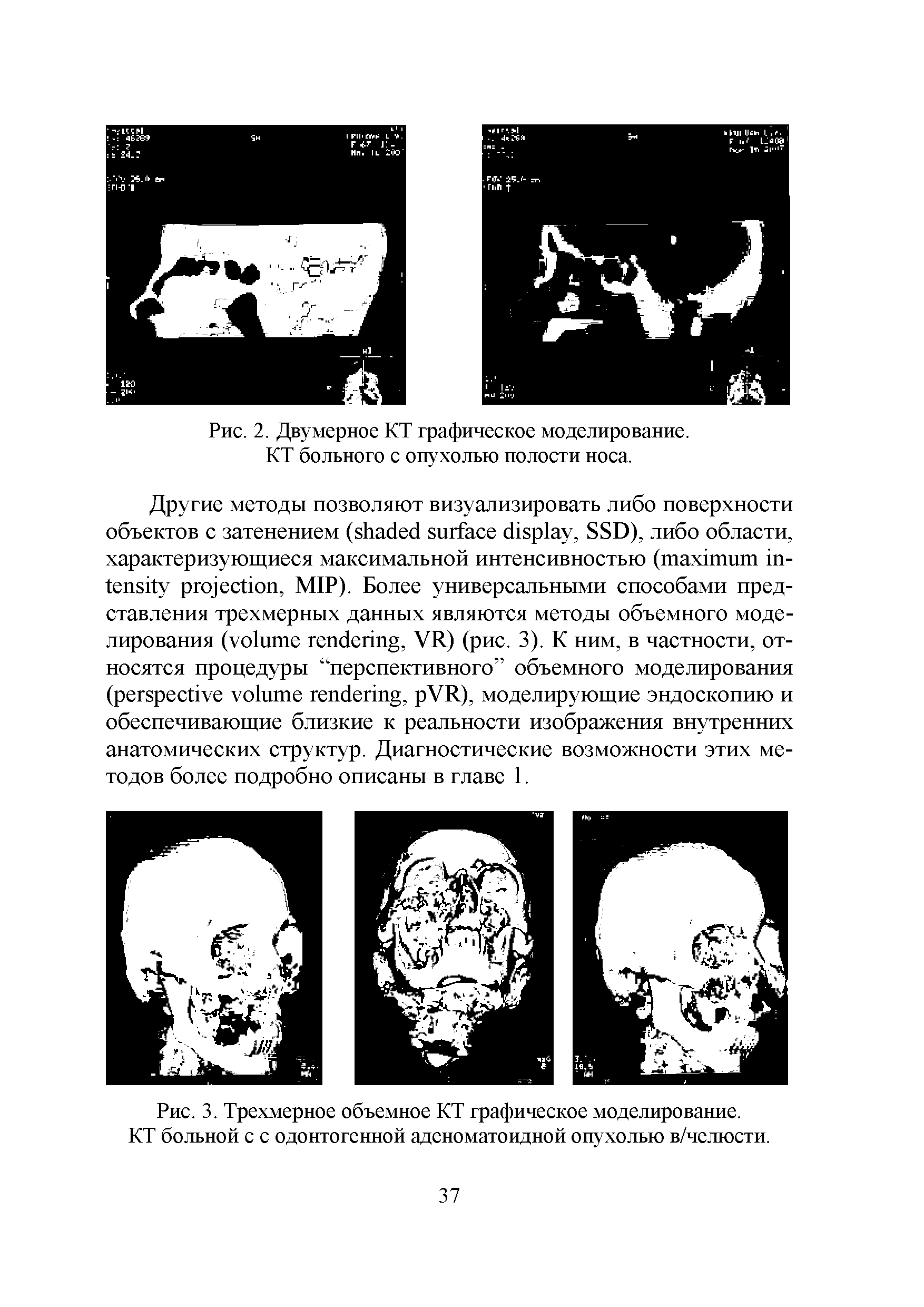 Рис. 3. Трехмерное объемное КТ графическое моделирование. КТ больной с с одонтогенной аденоматоидной опухолью в/челюсти.