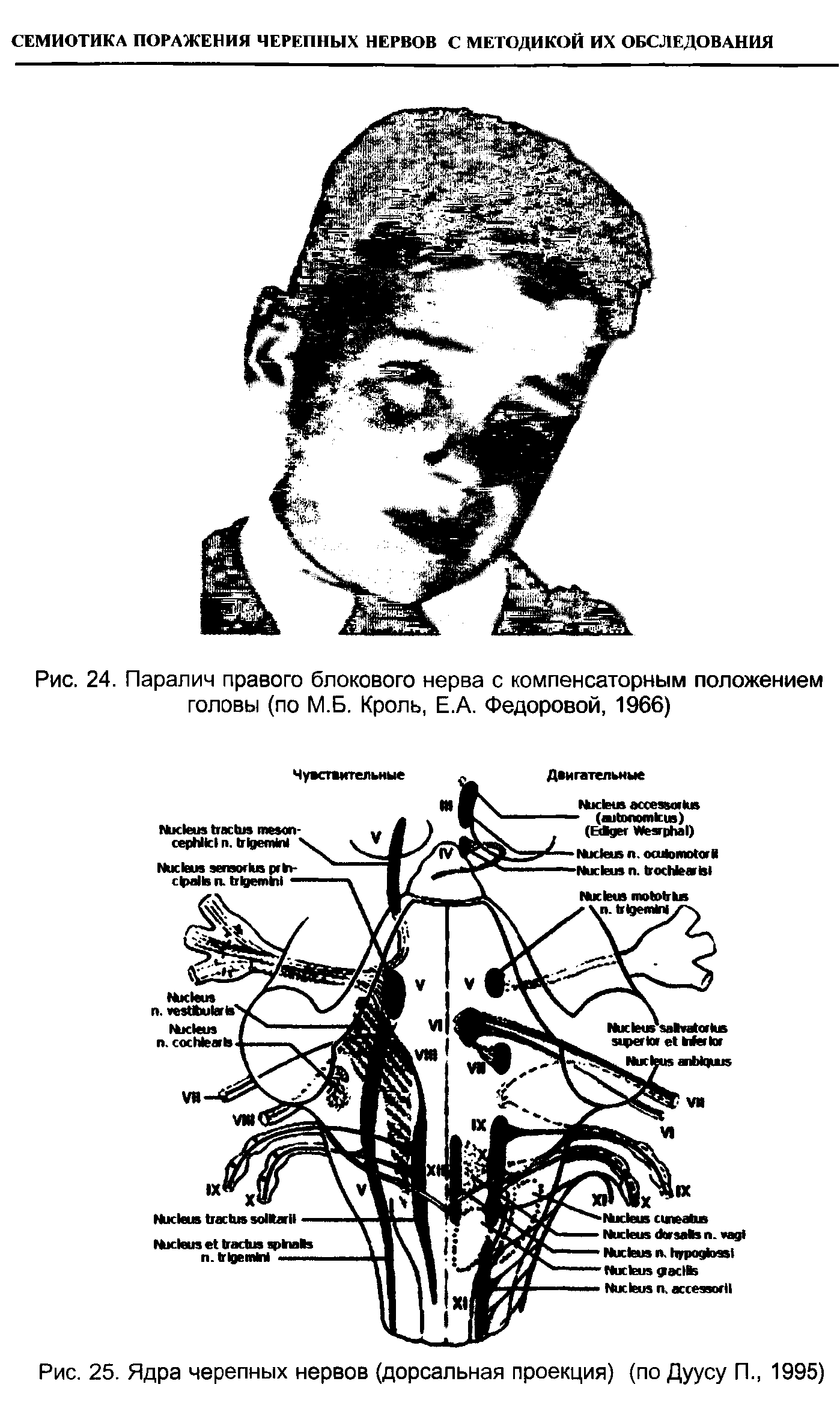 Рис. 24. Паралич правого блокового нерва с компенсаторным положением головы (по М.Б. Кроль, Е.А. Федоровой, 1966)...