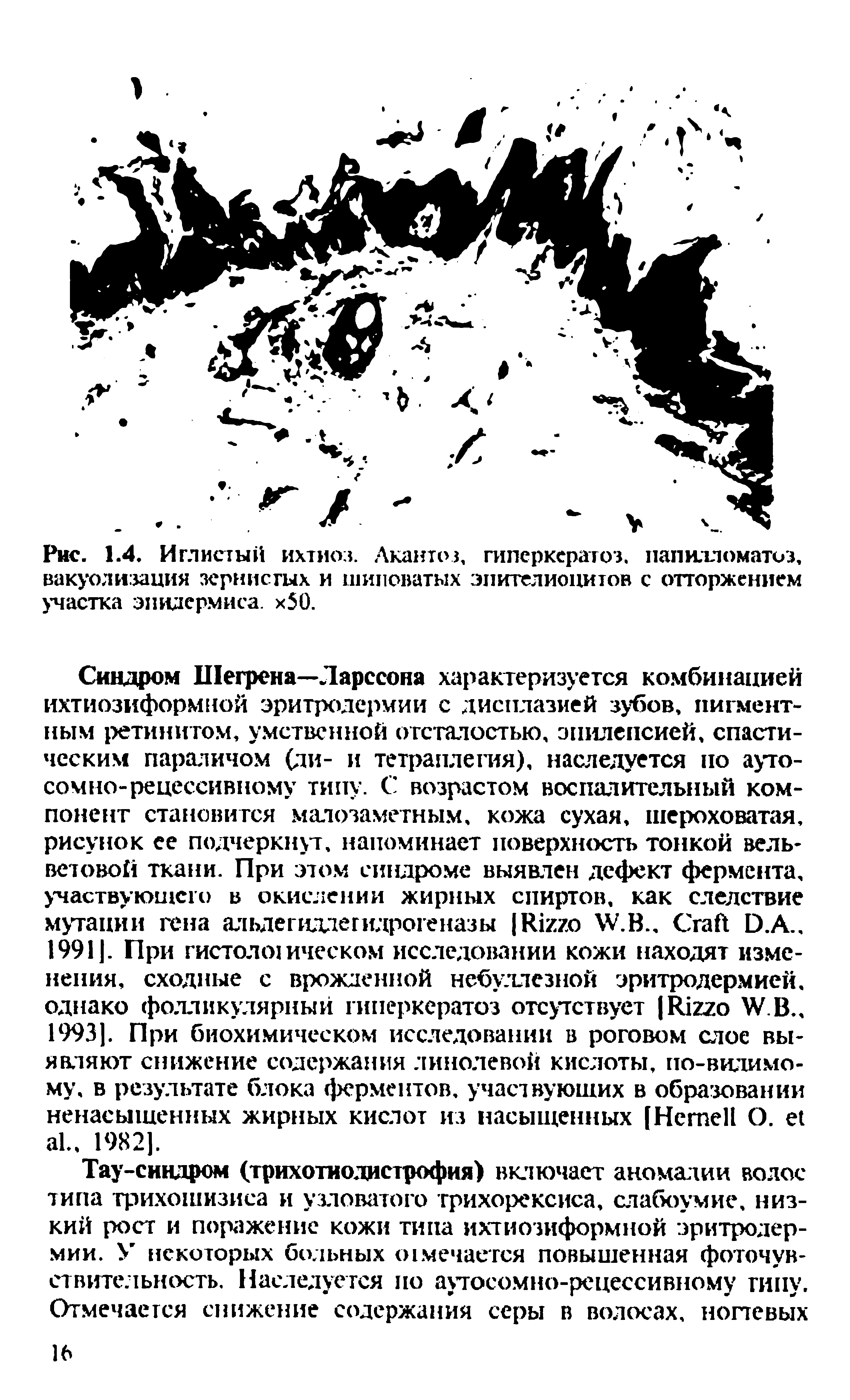 Рис. 1.4. Иглистый ихтиоз. Лкаитоз, гиперкератоз, папилломатоз, вакуолизация зернистых и шиповатых эпителиоцитов с отторжением участка эпидермиса. х50.