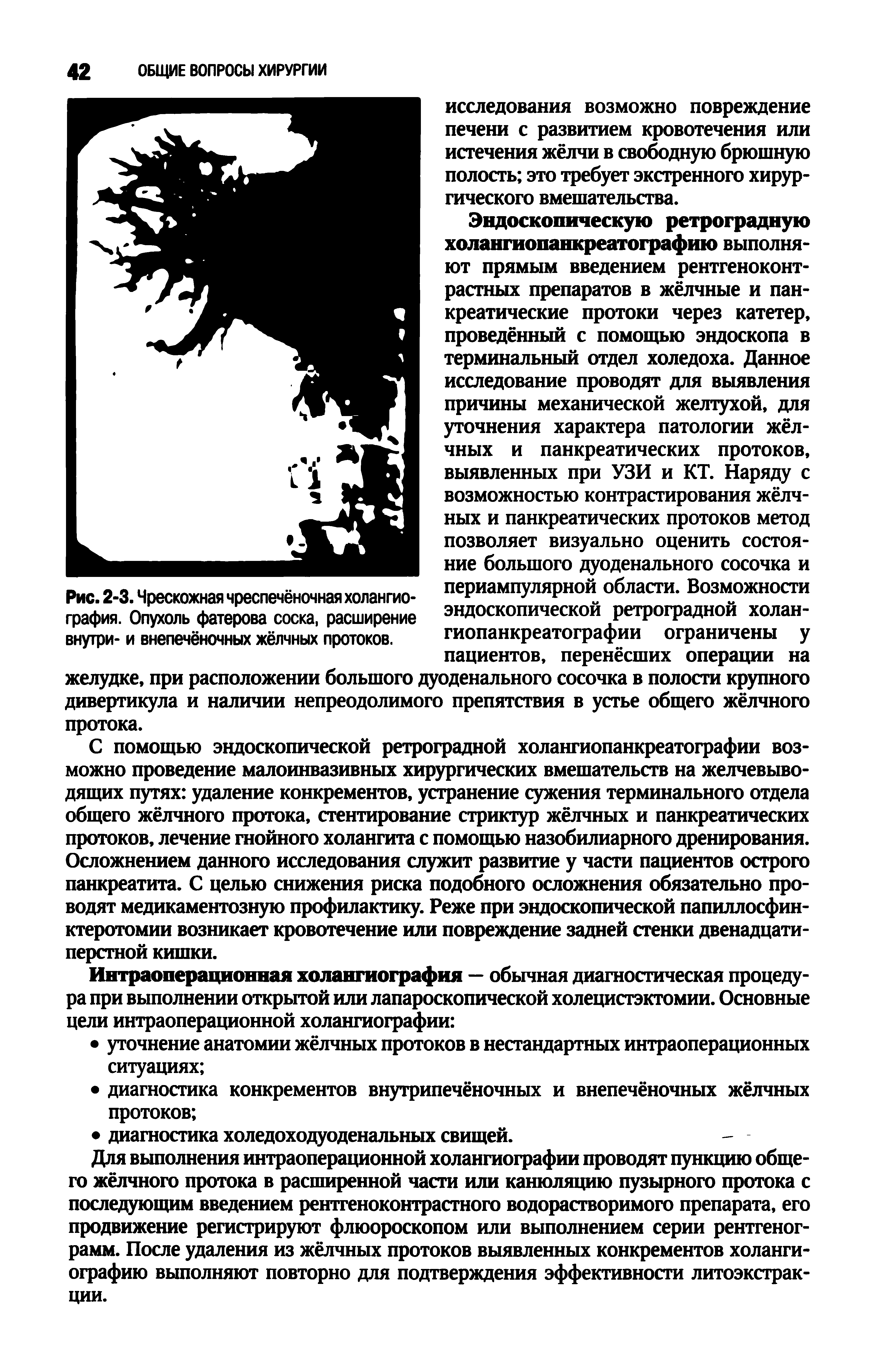 Рис. 2-3. Чрескожная чреспечёночная холангиография. Опухоль фатерова соска, расширение внутри- и внепечёночных жёлчных протоков.