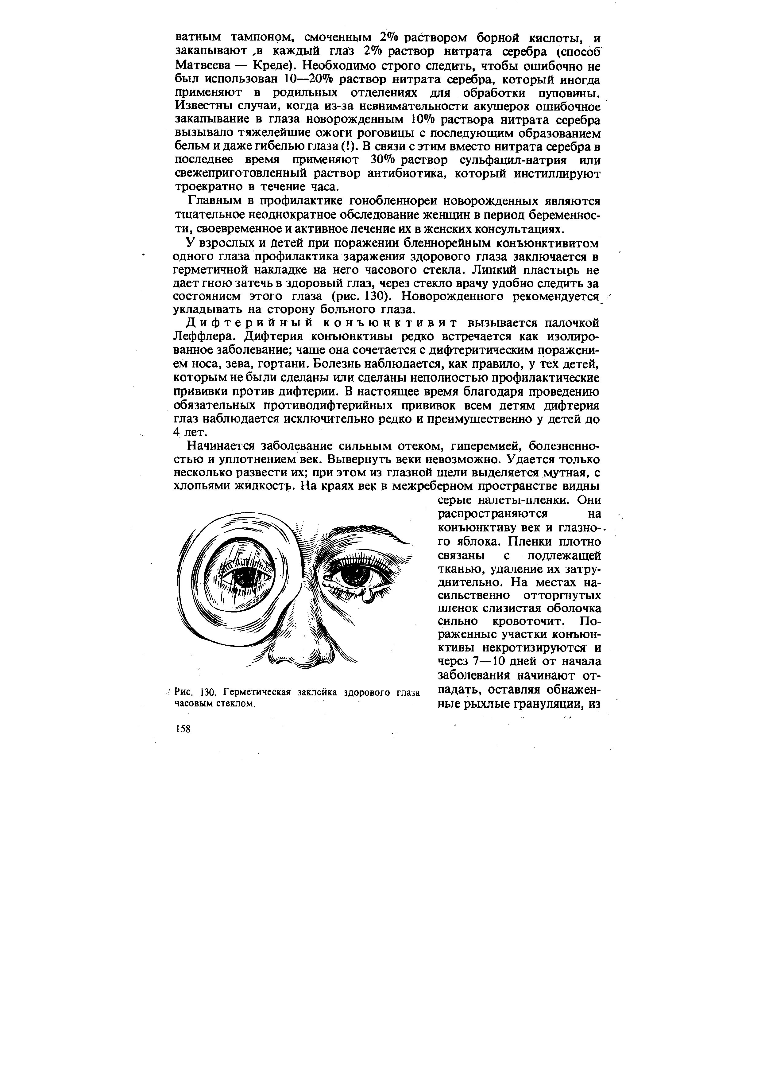 Рис. 130. Герметическая заклейка здорового глаза часовым стеклом.