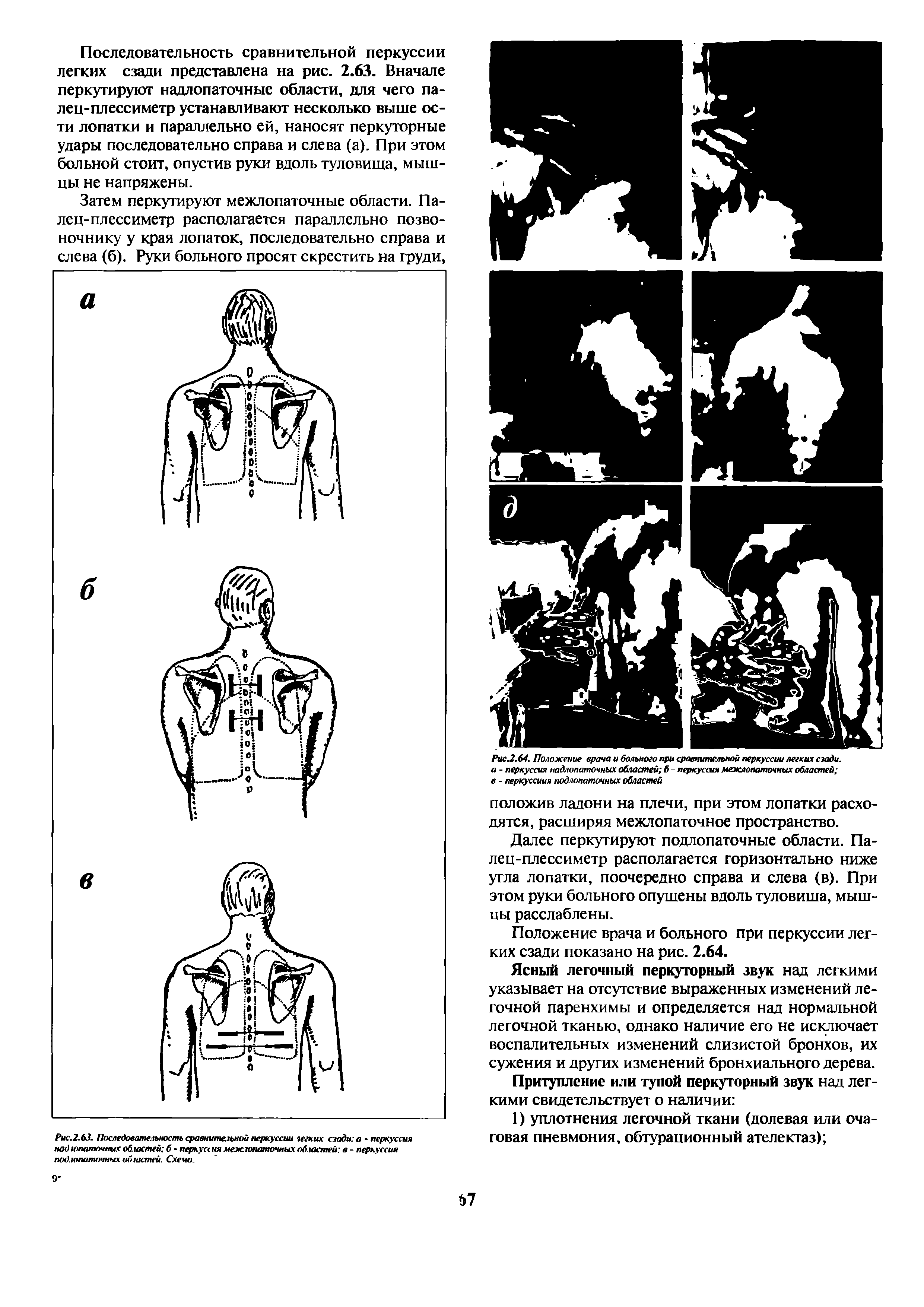 Рис.2.64. Положение врача и больного при сравнительной перкуссии легких сзади, а - перкуссия надлопаточных областей б - перкуссия межлопаточных областей в - перкуссиия подлопаточных областей...