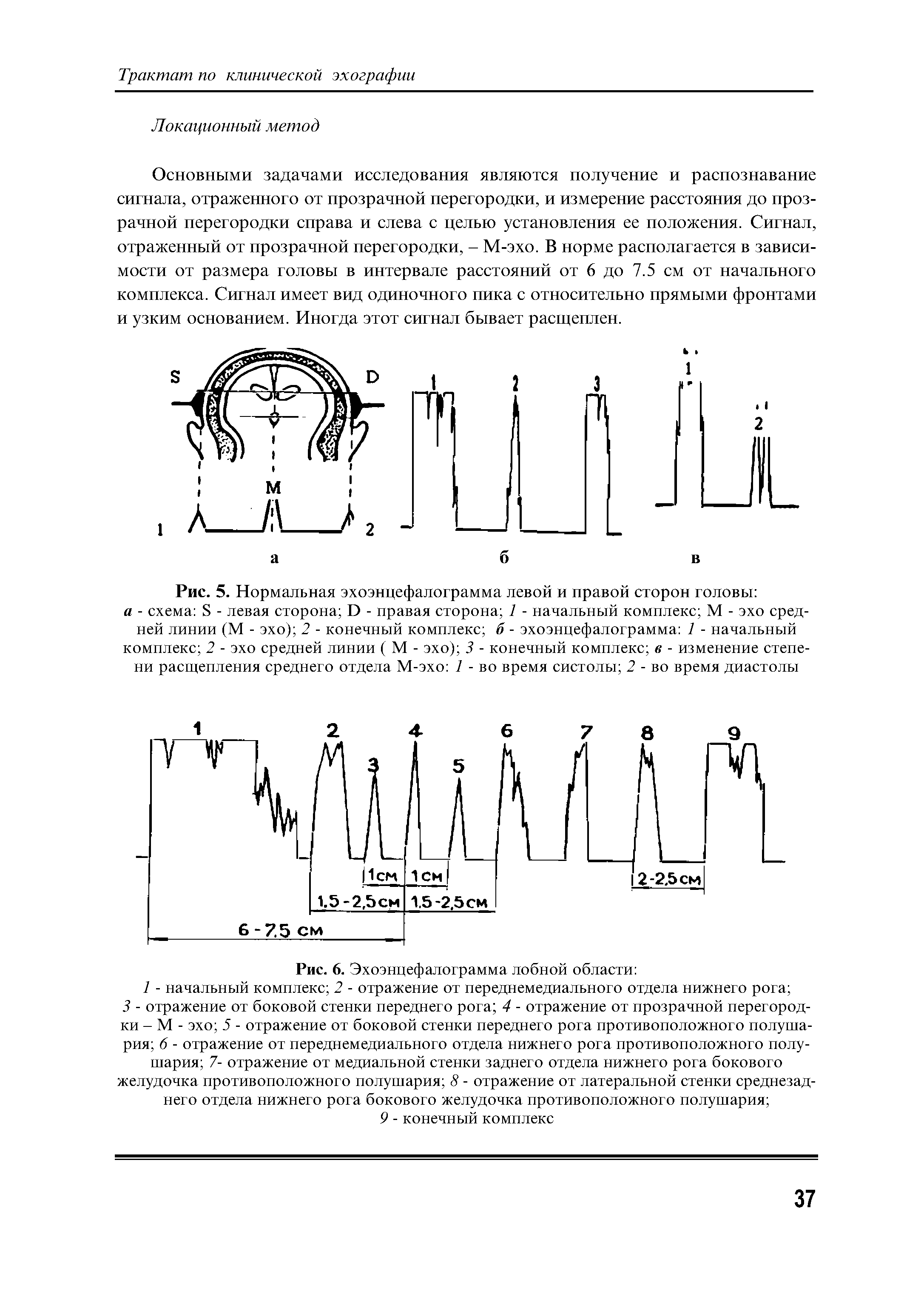 Рис. 5. Нормальная эхоэнцефалограмма левой и правой сторон головы а - схема 8 - левая сторона И - правая сторона 1 - начальный комплекс М - эхо средней линии (М - эхо) 2 - конечный комплекс б - эхоэнцефалограмма 1 - начальный комплекс 2 - эхо средней линии ( М - эхо) 3 - конечный комплекс в - изменение степени расщепления среднего отдела М-эхо 1 - во время систолы 2 - во время диастолы...