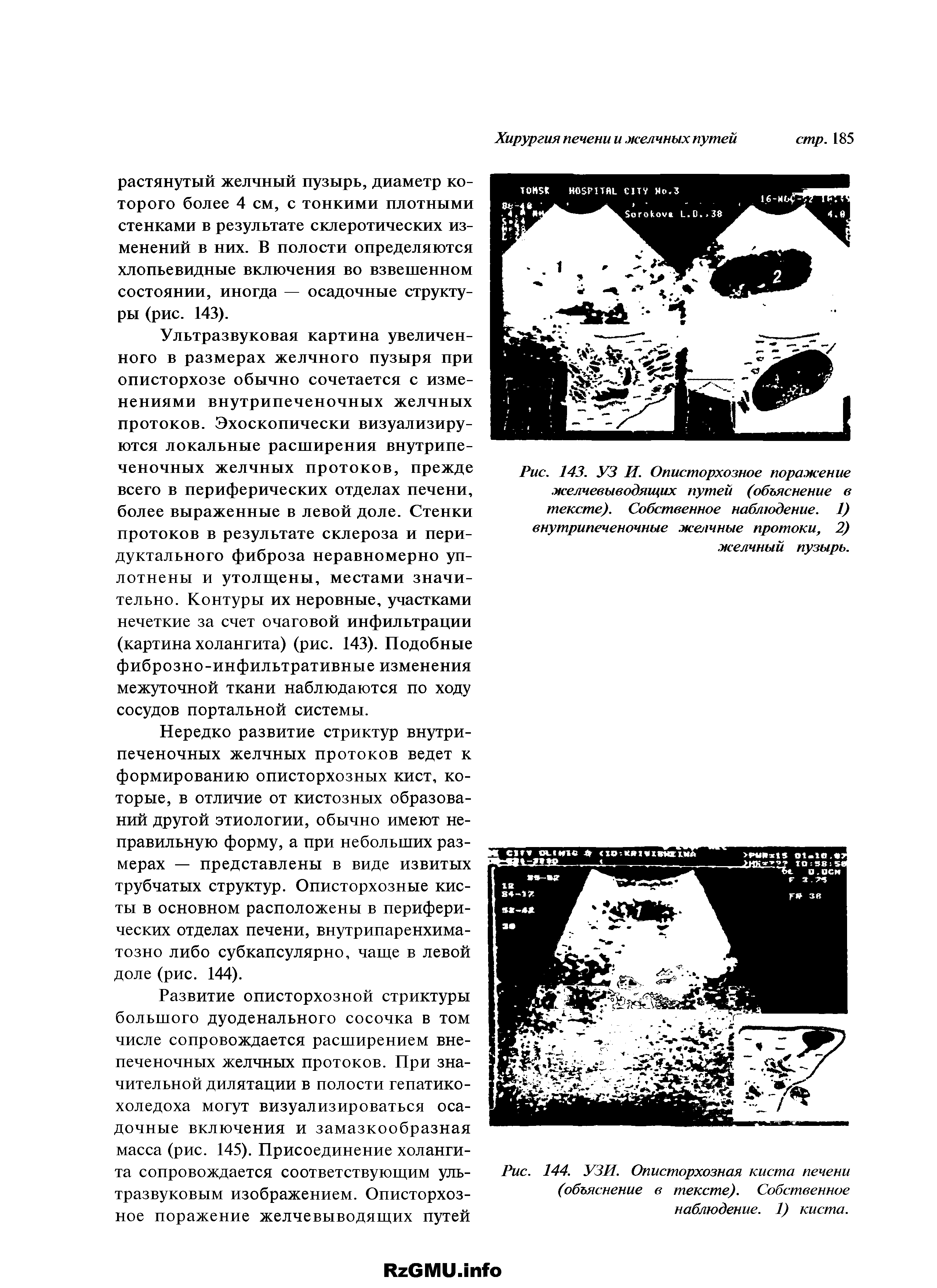 Рис. 144. УЗИ. Описторхозная киста печени (объяснение в тексте). Собственное наблюдение. 1) киста.