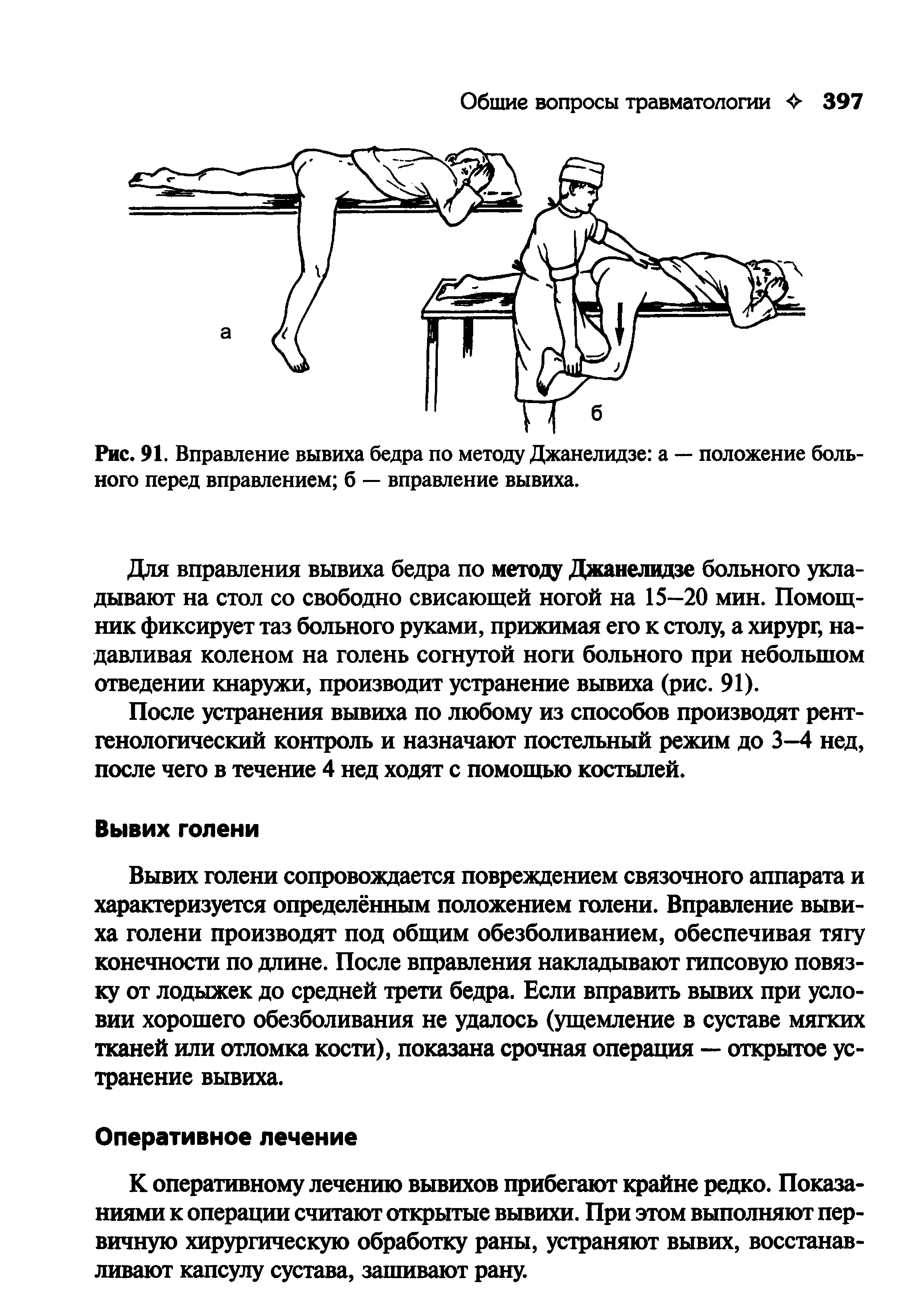 Рис. 91. Вправление вывиха бедра по методу Джанелидзе а — положение больного перед вправлением б — вправление вывиха.