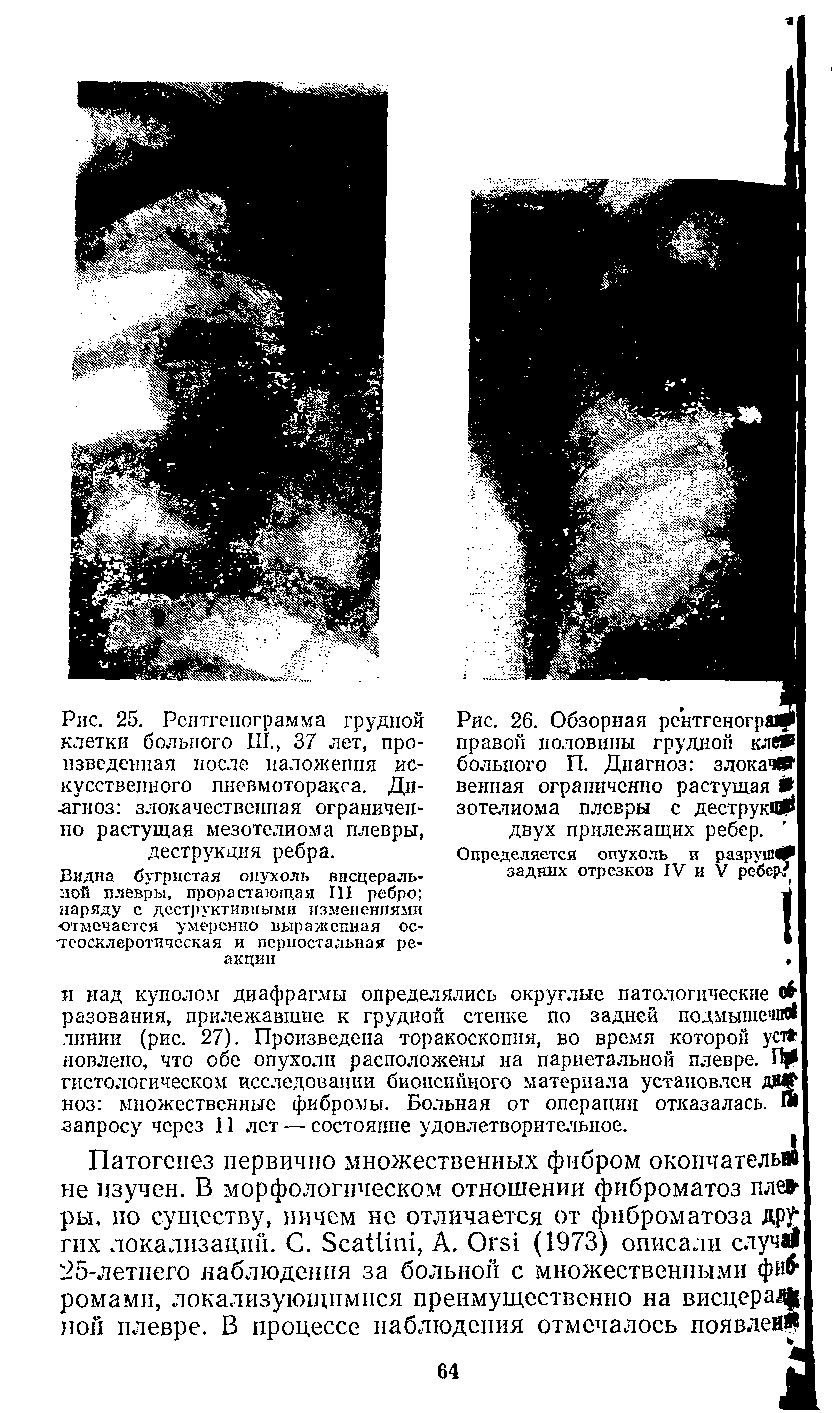 Рис. 25. Рентгенограмма грудной клетки больного Ш., 37 лет, произведенная после наложения искусственного пневмоторакса. Диагноз злокачественная ограниченно растущая мезотелиома плевры, деструкция ребра.