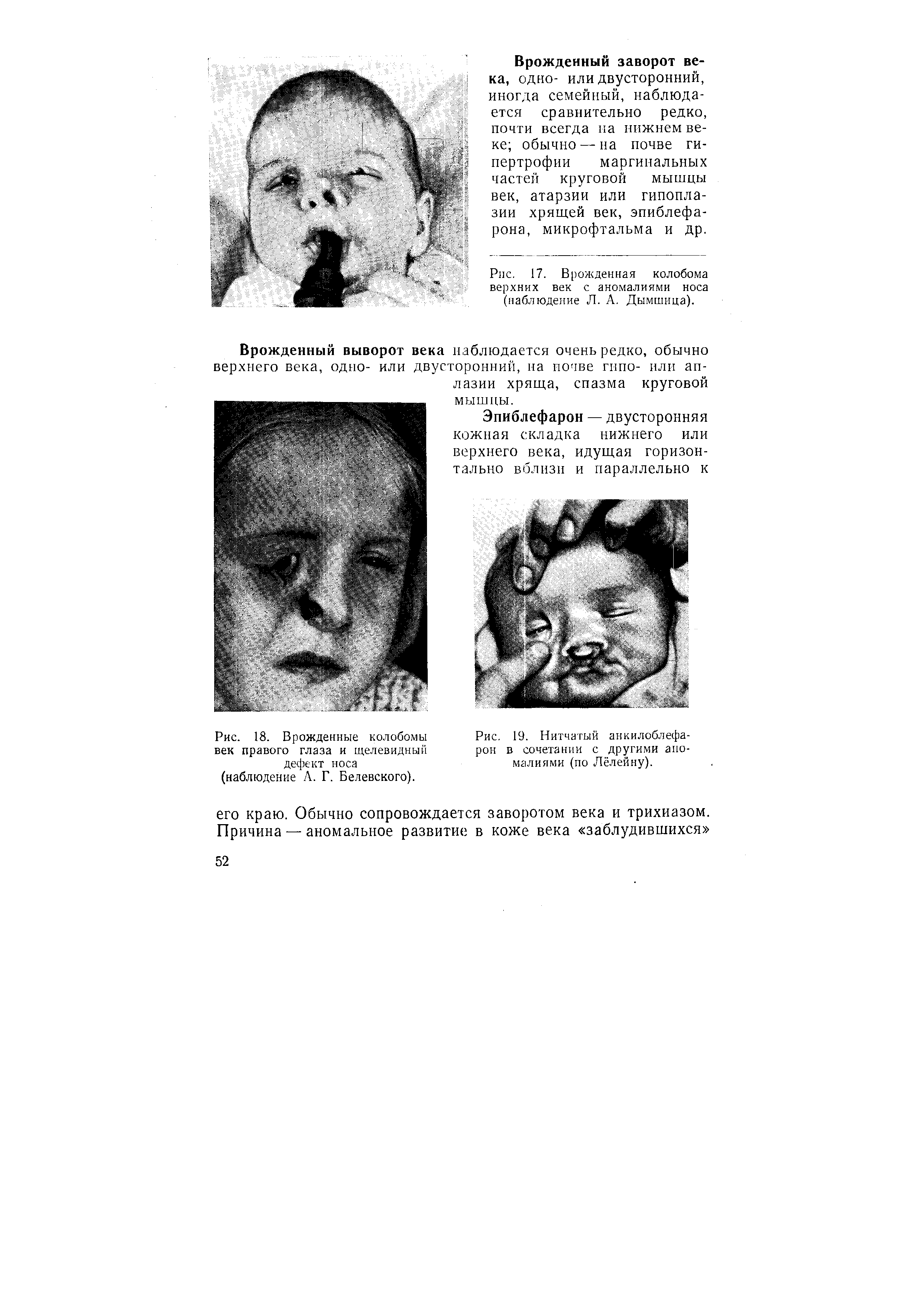 Рис. 17. Врожденная колобома верхних век с аномалиями носа (наблюдение Л. А. Дымшица).