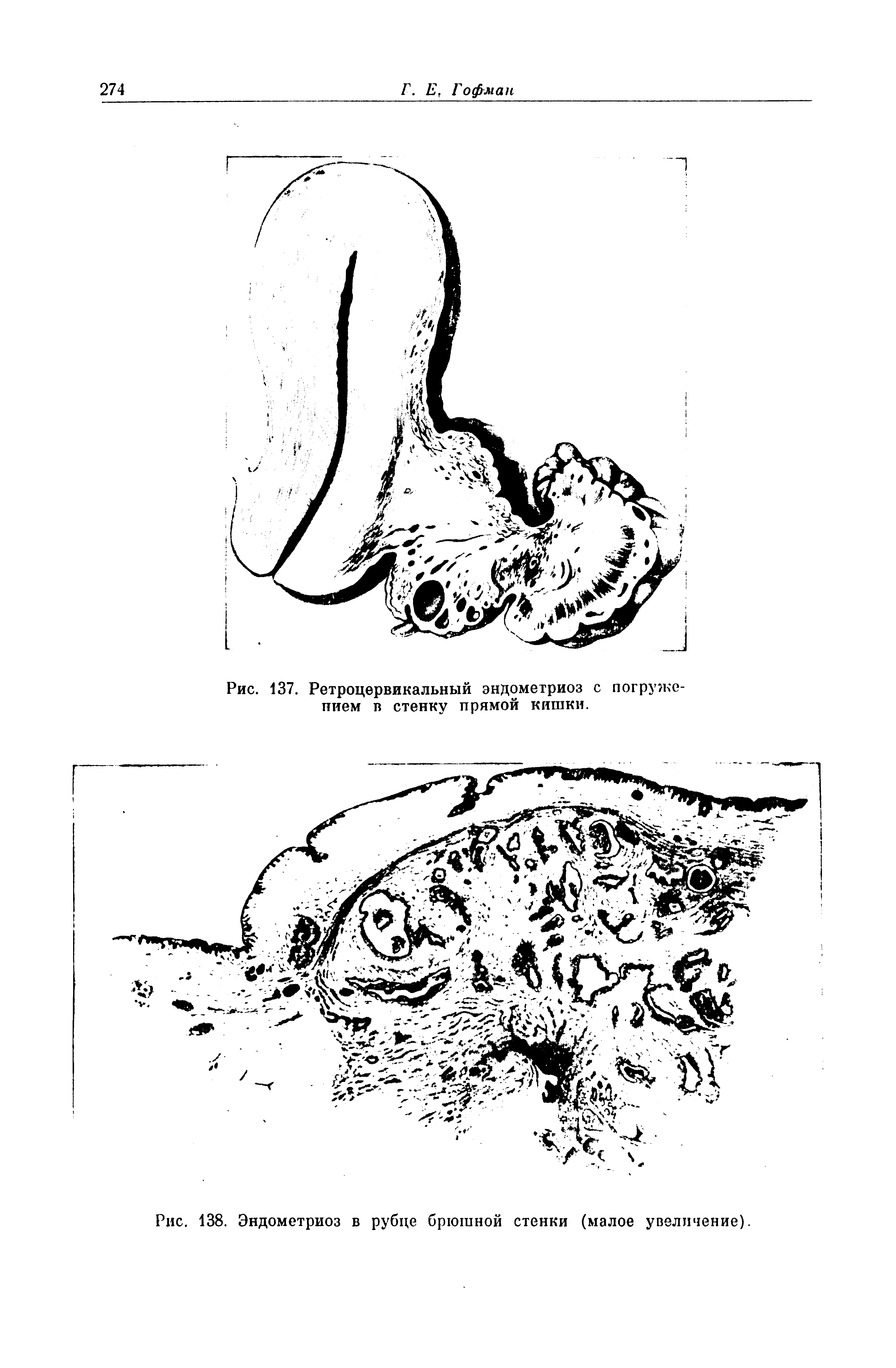 Рис. 138. Эндометриоз в рубце брюшной стенки (малое увеличение).