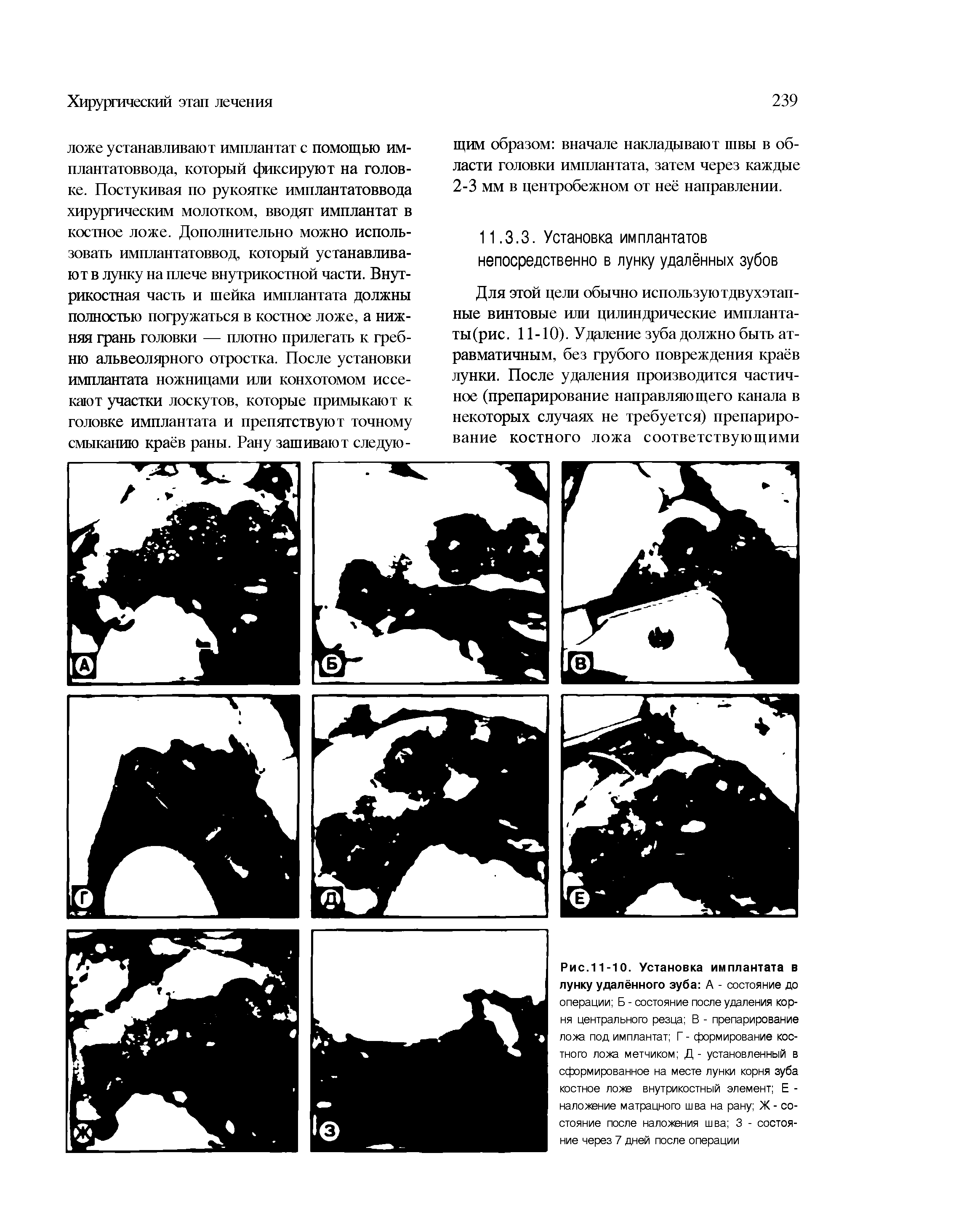 Рис.11-10. Установка имплантата в лунку удалённого зуба А - состояние до операции Б - состояние после удаления корня центрального резца В - препарирование ложа под имплантат Г - формирование костного ложа метчиком Д- установленный в сформированное на месте лунки корня зуба костное ложе внутрикостный элемент Е -наложение матрацного шва на рану Ж - состояние после наложения шва 3 - состояние через 7 дней после операции...