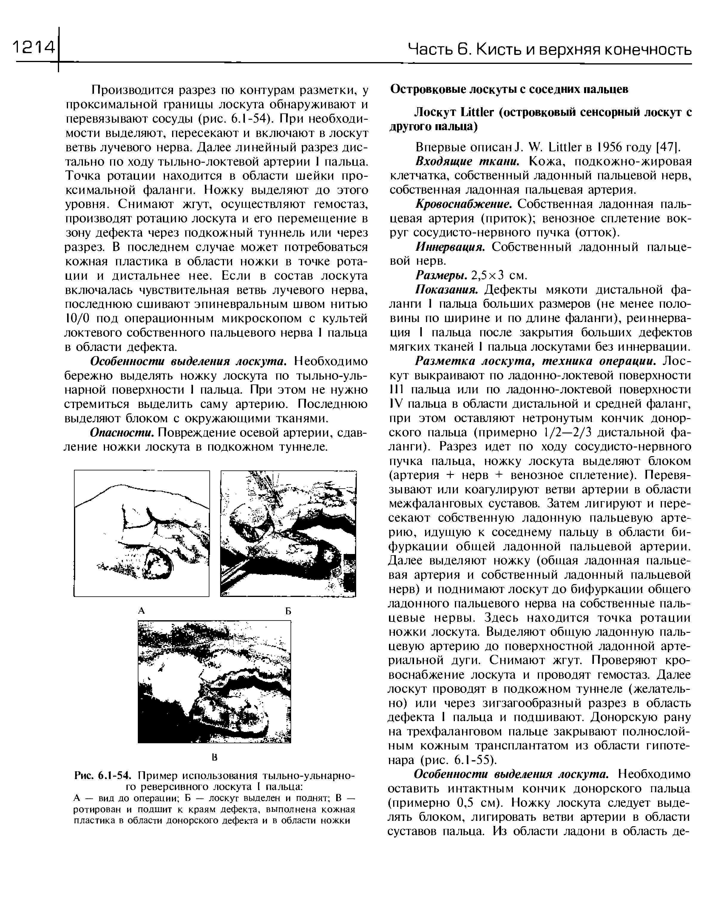 Рис. 6.1-54. Пример использования тыльно-ульнарного реверсивного лоскута I пальца ...