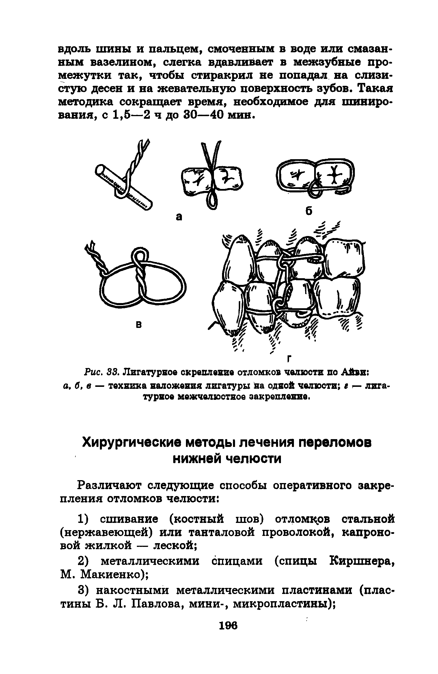 Рис. 33. Лигатурное скрепление отломков челюсти по Айви а, б, в — техника наложения лигатуры на одной челюсти г лигатурное межчелюстное закрепление.