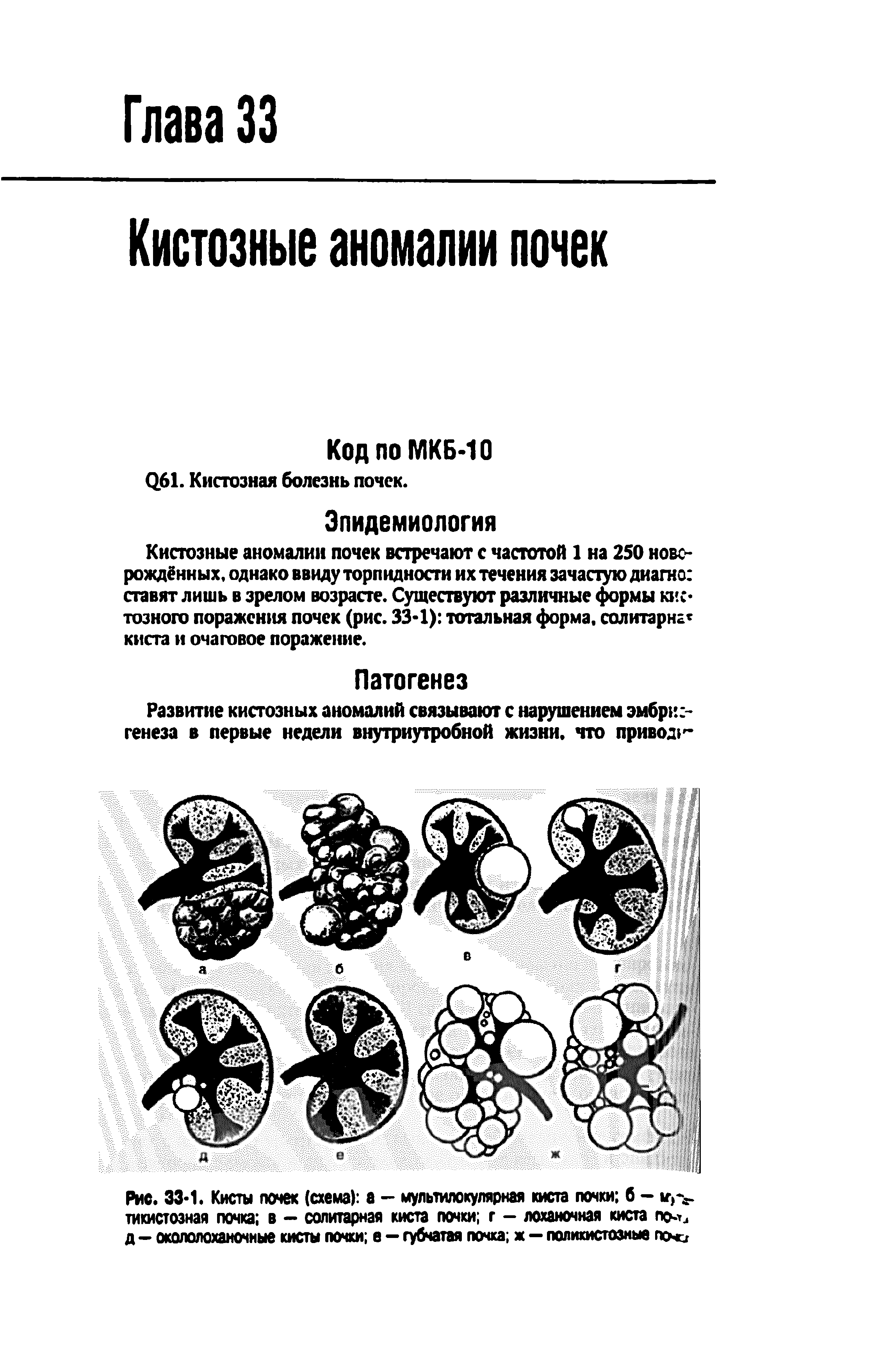 Рис. 33 1. Кисты почек (схема) а - мультилокулярная киста почки б -тикистозная почка в - солитарная киста почки г - лоханочная киста по-ъ д - окололоханочные кисты почки е - губчатая почка ж - поликистозные пени...