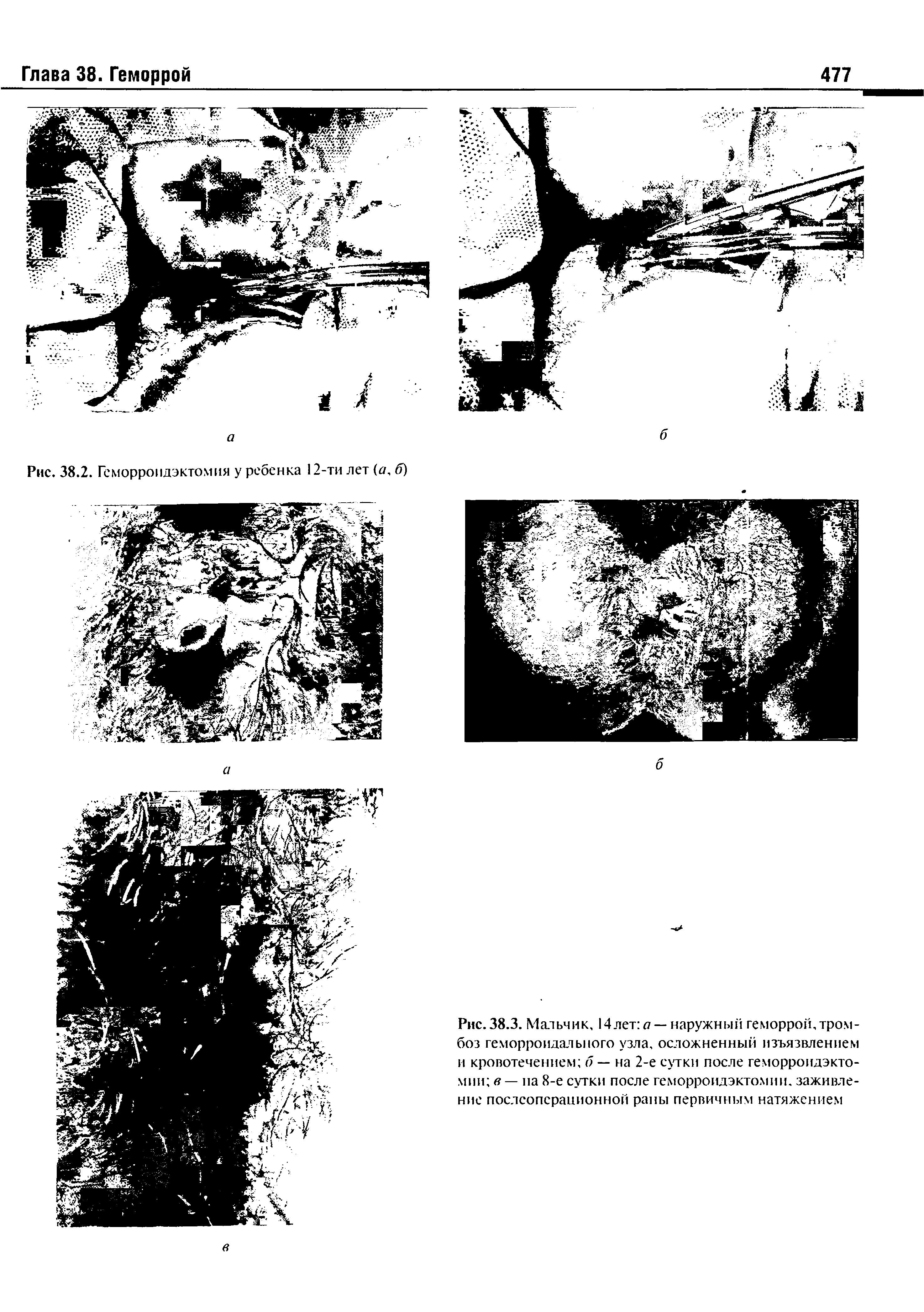 Рис. 38.3. Мальчик, 14 лет я — наружный геморрой, тромбоз геморроидального узла, осложненный изъязвлением и кровотечением б — на 2-е сутки после геморроидэкто-мии в — па 8-е сутки после геморроидэктомии. заживление послеоперационной раны первичным натяжением...