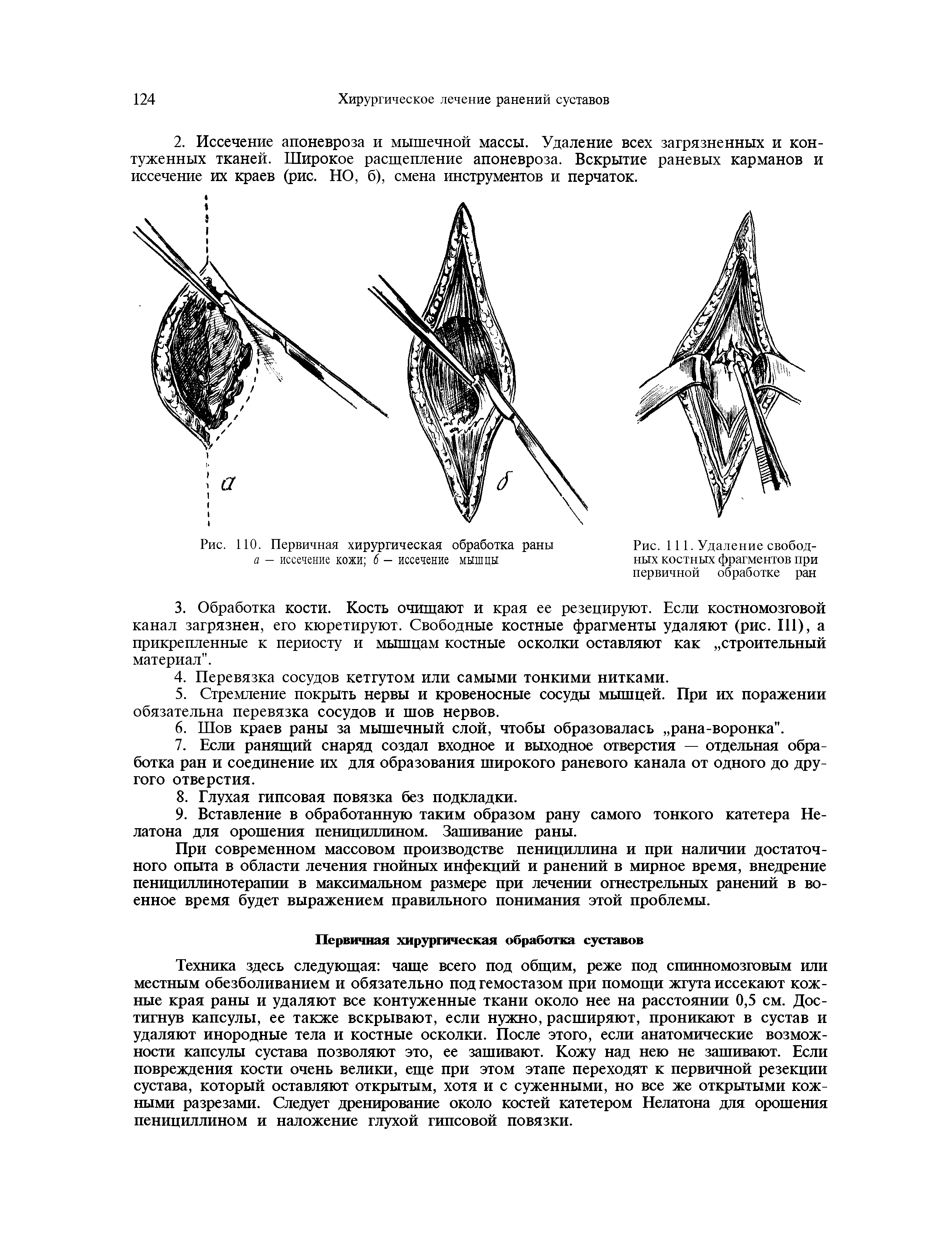 Рис. 110. Первичная хирургическая обработка раны а - иссечение кожи 6 - иссечение мышцы...