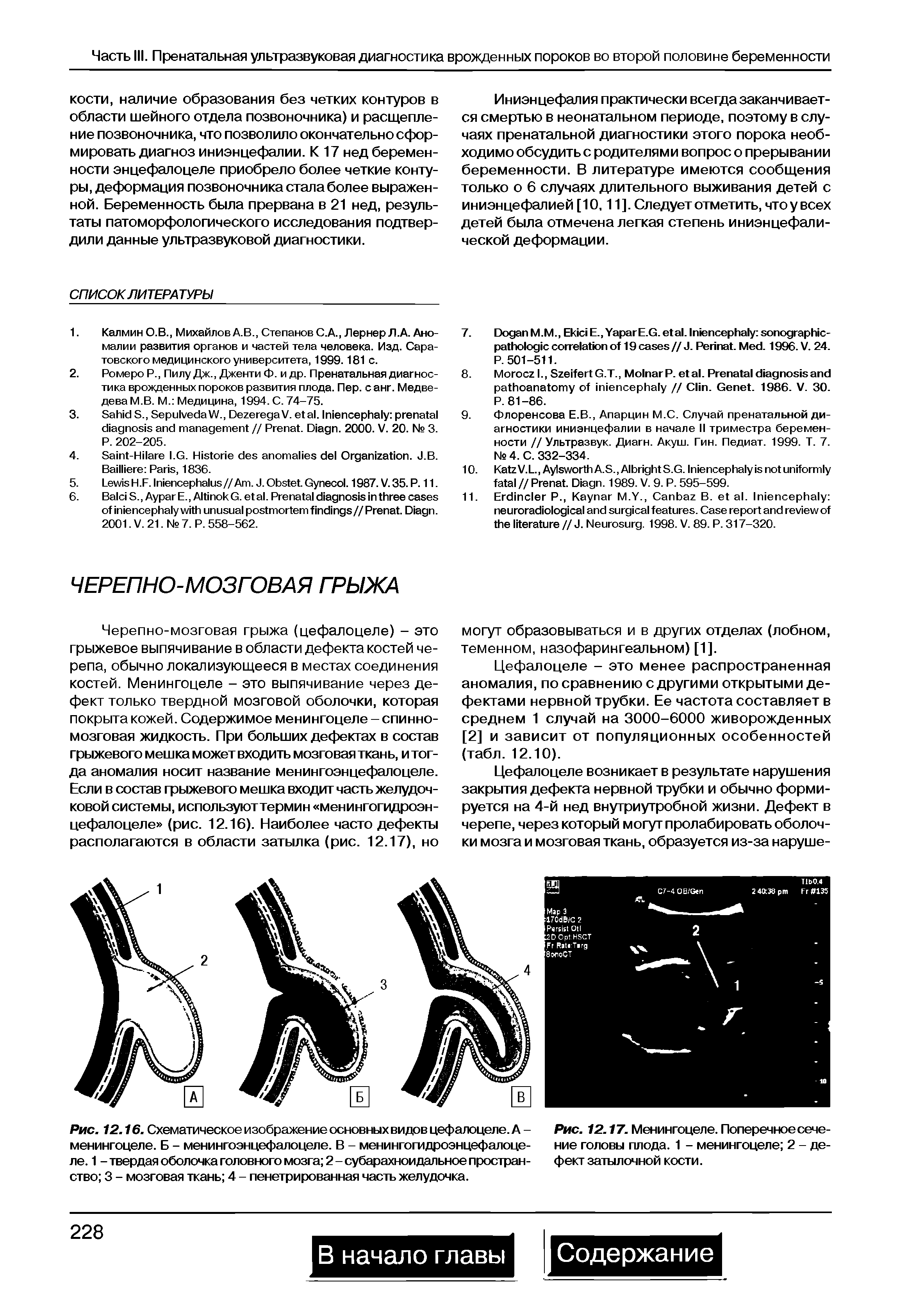 Рис. 12.16. Схематическое изображение основных видов цефалоцеле. А -менингоцеле. Б - менингоэнцефалоцеле. В - менингогидроэнцефалоце-ле. 1 - твердая оболочка головного мозга 2 - субарахноидальное пространство 3 - мозговая ткань 4 - пенетрированная часть желудочка.