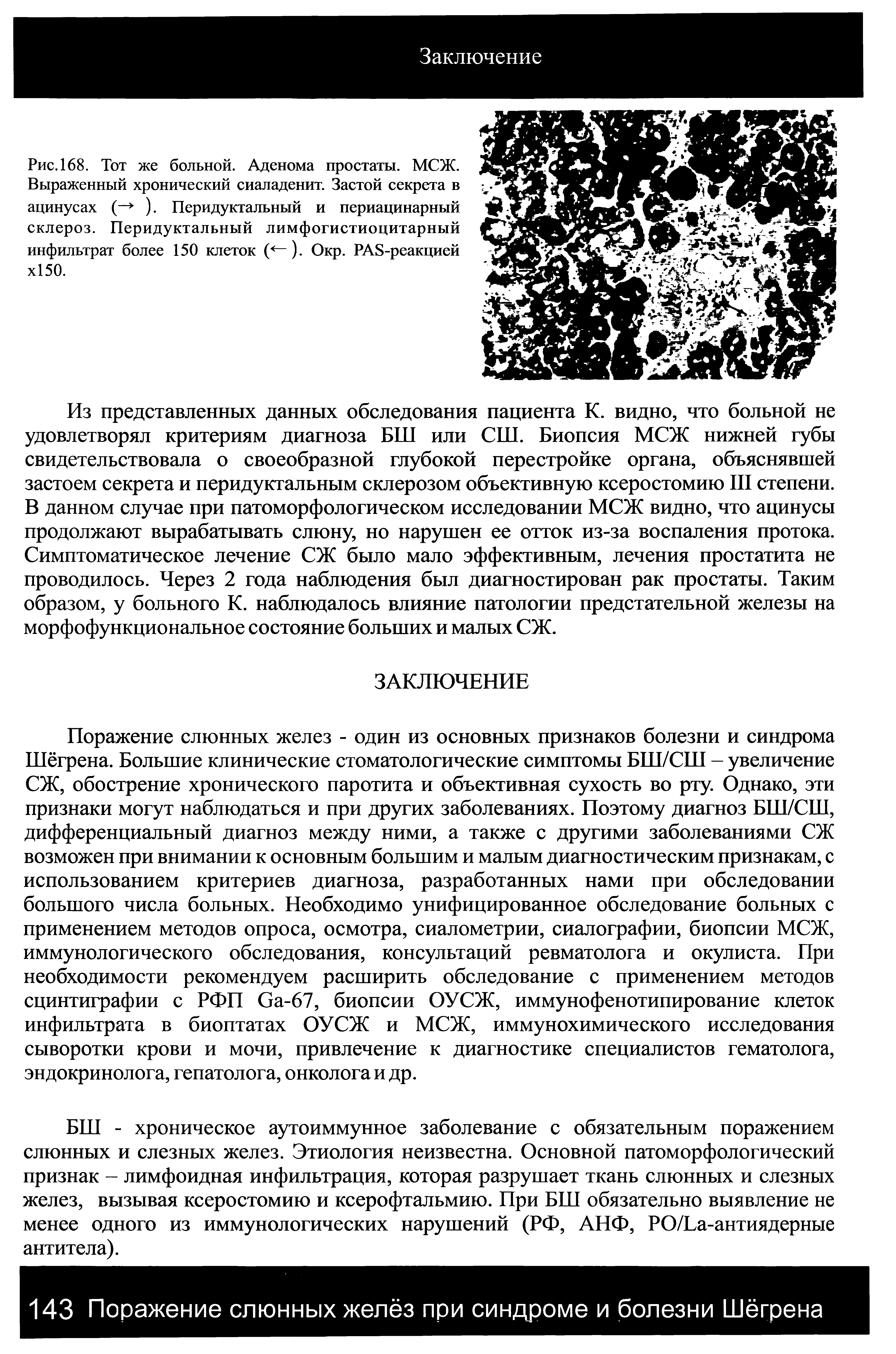 Рис. 168. Тот же больной. Аденома простаты. МСЖ. Выраженный хронический сиаладенит. Застой секрета в ацинусах (— ). Перидуктальный и периацинарный склероз. Перидуктальный лимфогистиоцитарный инфильтрат более 150 клеток (<—). Окр. РА8-реакцией х150.