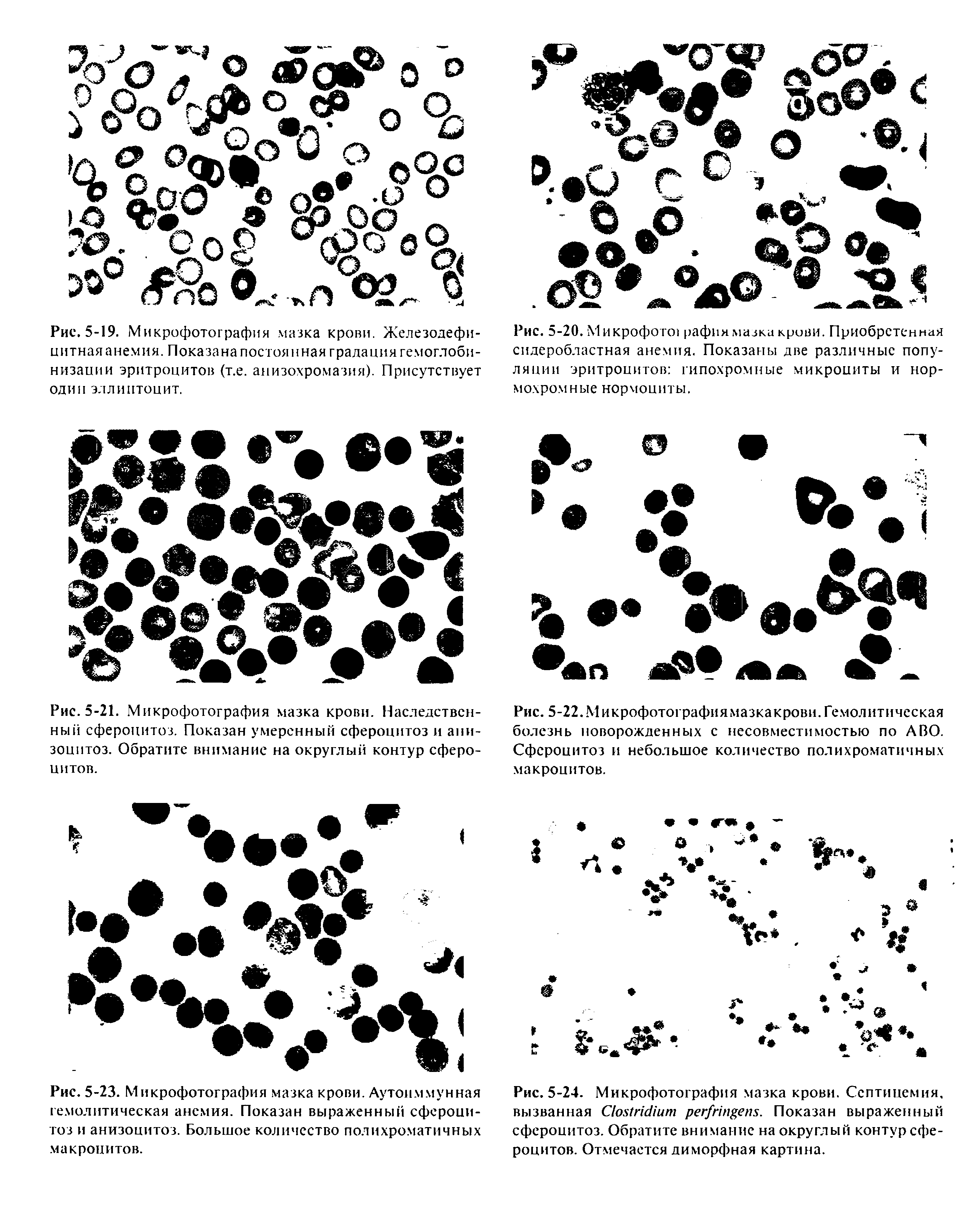 Рис. 5-20. Микрофото1 рафия мазка крови. Приобретенная сидеробластная анемия. Показаны две различные популяции эритроцитов гипохромные микроциты и нормохромные нормоциты.