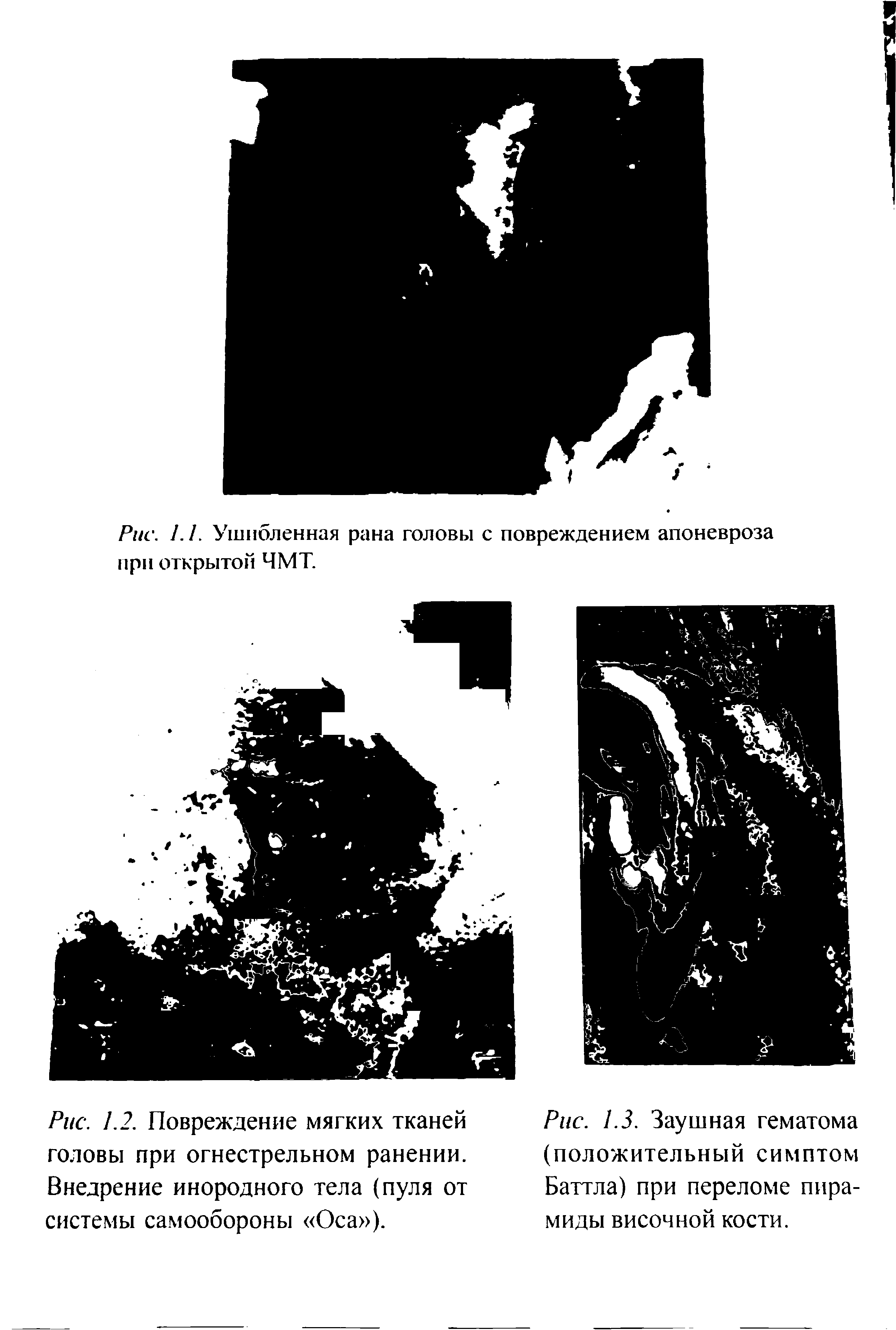 Рис. 1.3. Заушная гематома (положительный симптом Баттла) при переломе пирамиды височной кости.