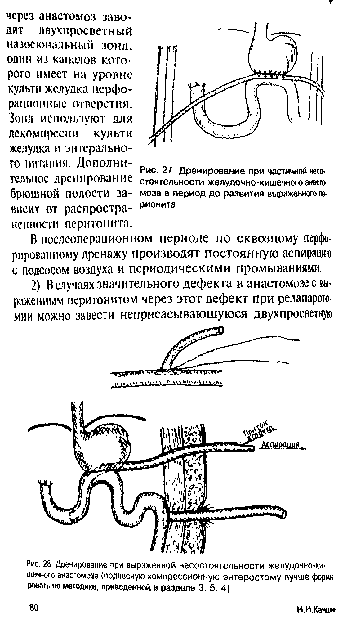 Рис. 27. Дренирование при частичной несостоятельности желудочно-кишечного анастомоза 8 период до развития выраженного пе-рионита...