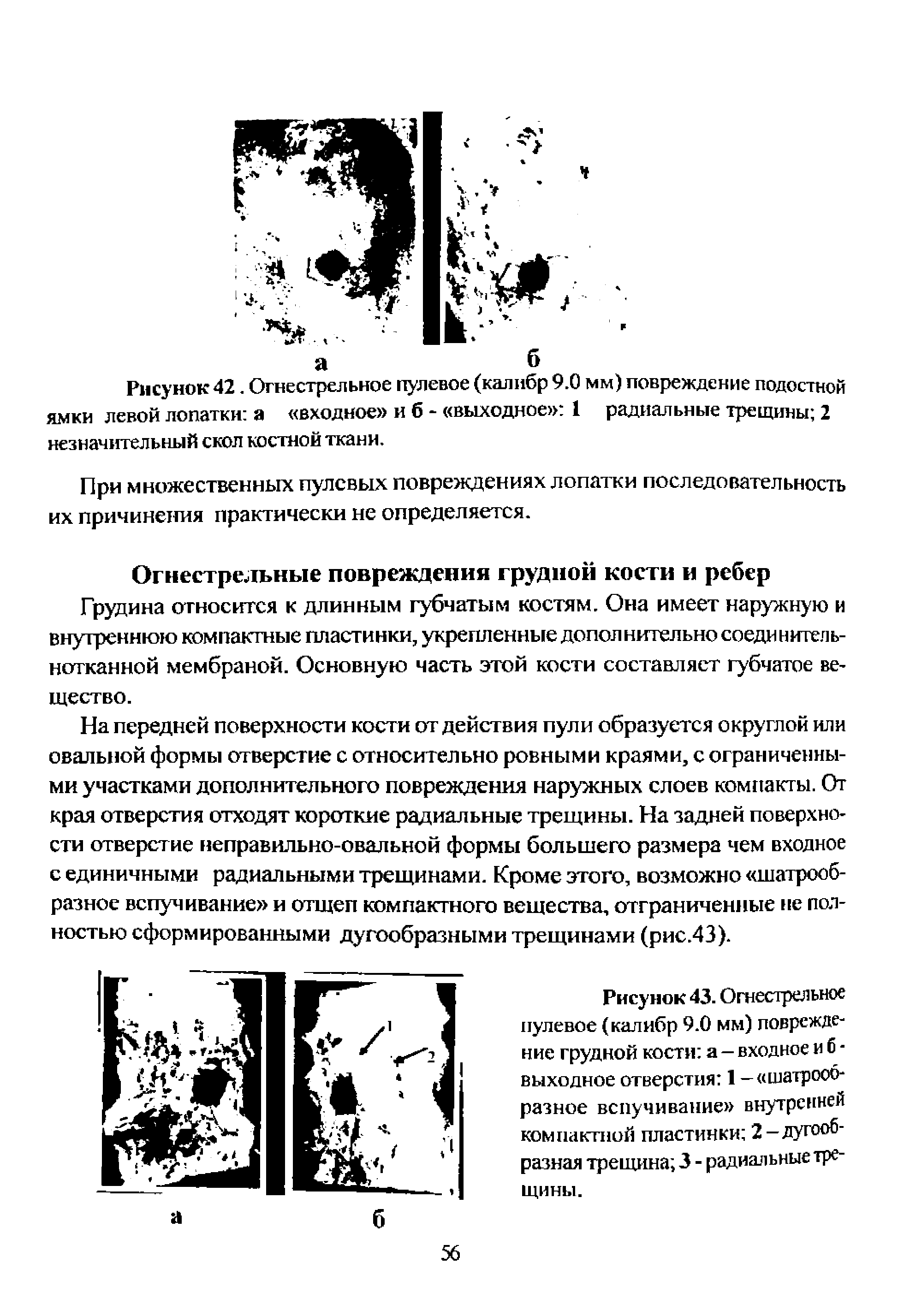 Рисунок 42. Огнестрельное пулевое (калибр 9.0 мм) повреждение подостной ямки левой лопатки а входное и б - выходное 1 радиальные трещины 2 незначительный скол костной ткани.