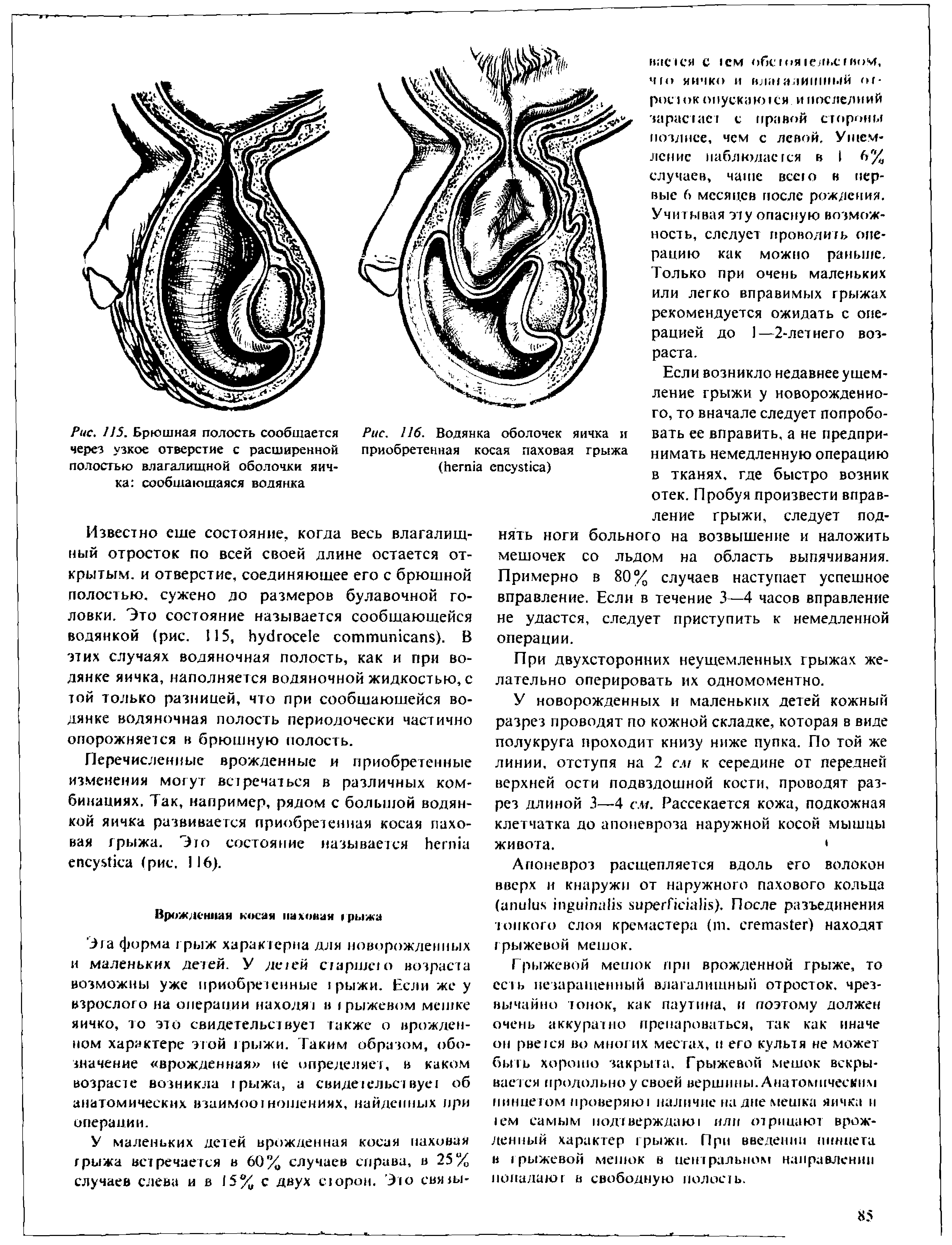 Рис. 115. Брюшная полость сообщается через узкое отверстие с расширенной полостью влагалищной оболочки яичка сообщающаяся водянка...