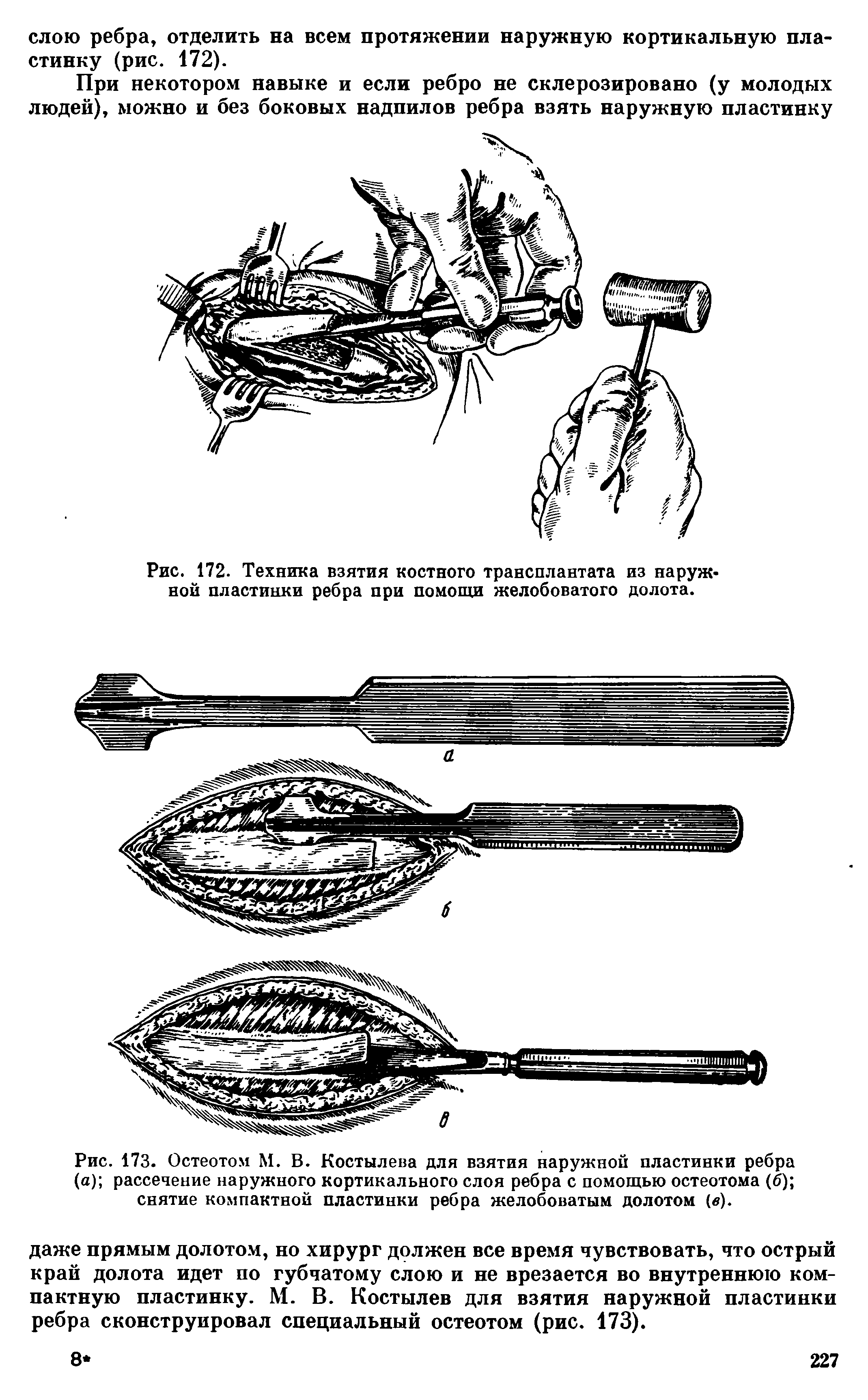 Рис. 173. Остеотом М. В. Костылева для взятия наружной пластинки ребра (а) рассечение наружного кортикального слоя ребра с помощью остеотома (б) снятие компактной пластинки ребра желобоватым долотом (в).