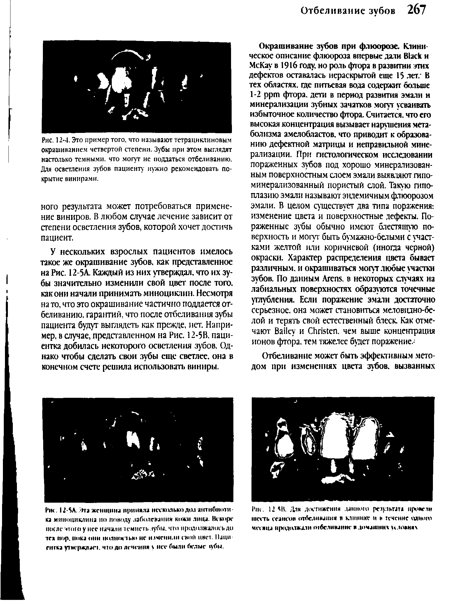 Рис. 12-4. Это пример того, что называют тетрациклиновым окрашиванием четвертой степени. Зубы при этом выглядят настолько темными, что могут не поддаться отбеливанию. Для осветления зубов пациенту нужно рекомендовать по-...